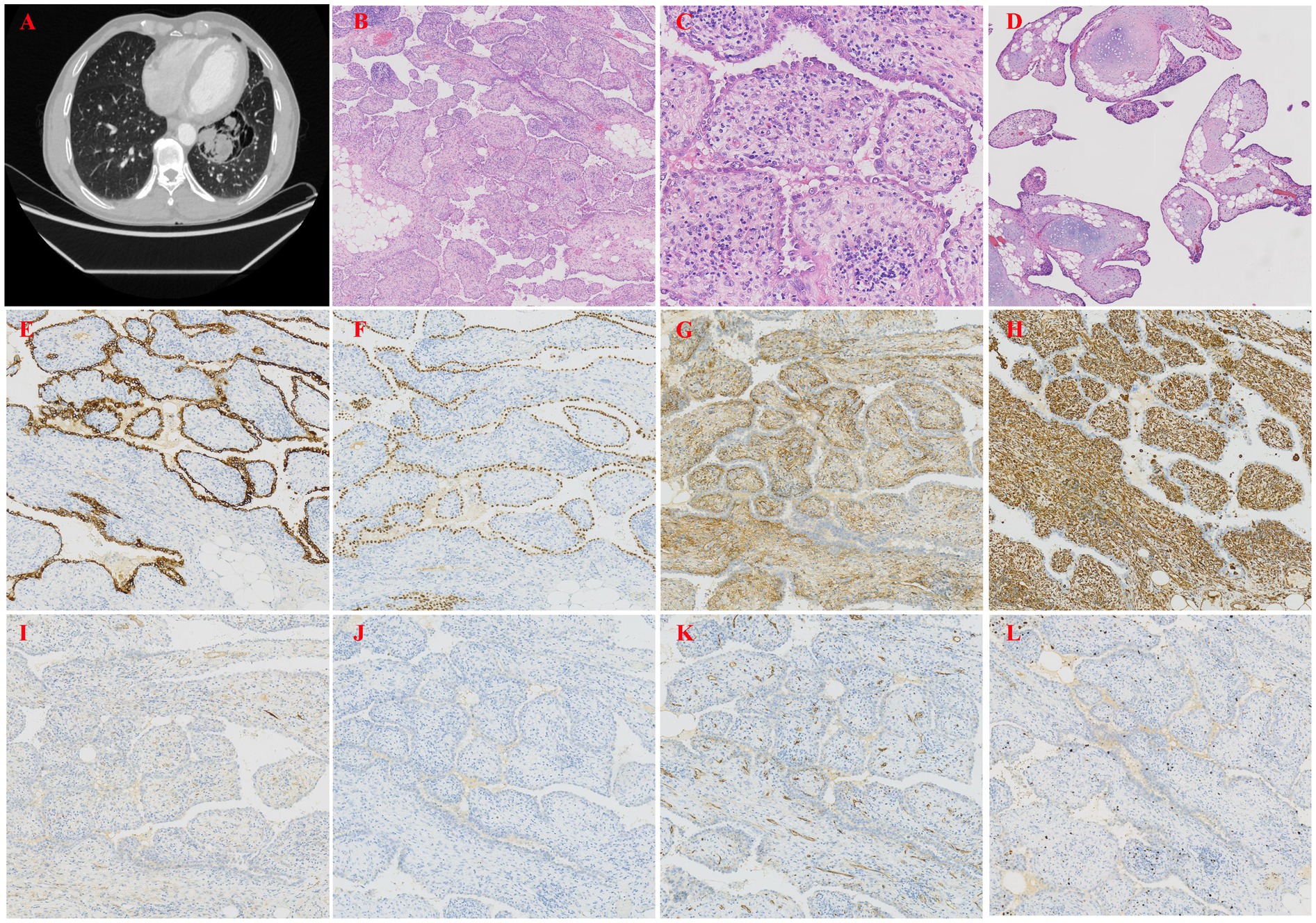 A series of medical images showing a lung CT scan and various histological analyses. Panel A shows a CT scan of the chest highlighting lung details. Panels B, C, and D display histological sections with hematoxylin and eosin staining, showing varying cellular structures. Panels E to H present immunohistochemical staining patterns, indicating protein expression in different tissues. Panels I to L show additional immunohistochemical analyses with less pronounced staining, suggesting a difference in protein presence.