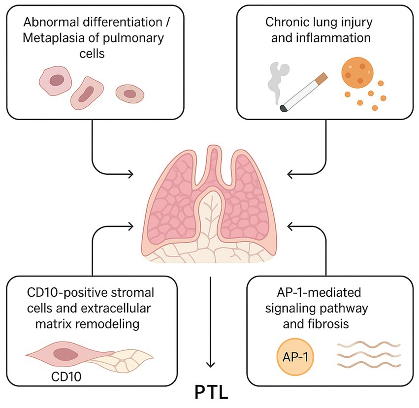 Diagram depicting factors contributing to pulmonary transformation labeled PTL. It includes abnormal differentiation/metaplasia of pulmonary cells, chronic lung injury and inflammation illustrated with a cigarette, CD10-positive stromal cells with matrix remodeling, and AP-1 signaling pathway and fibrosis, leading to changes in lung tissue. Arrows indicate progression between these factors and their connection to PTL.