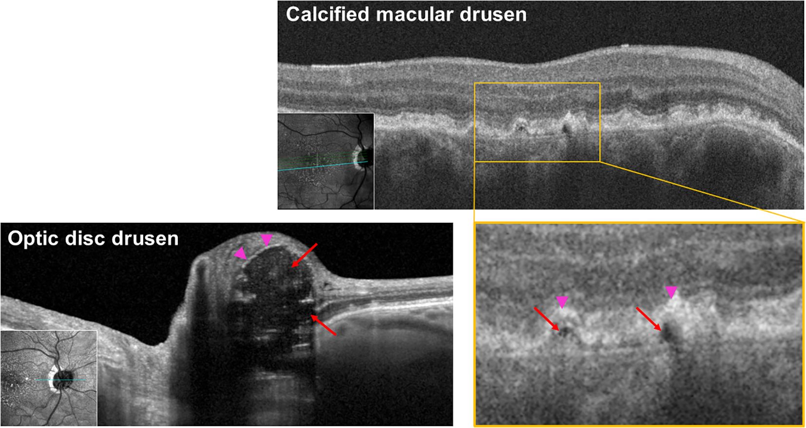 Optical coherence tomography images showing calcified macular drusen and optic disc drusen. The macular drusen image has a large inset highlighting calcification features with arrows and triangle indicators. The optic disc drusen image shows various pointed areas marked with arrows and triangles, indicating drusen presence. Insets of fundus images provide location context.