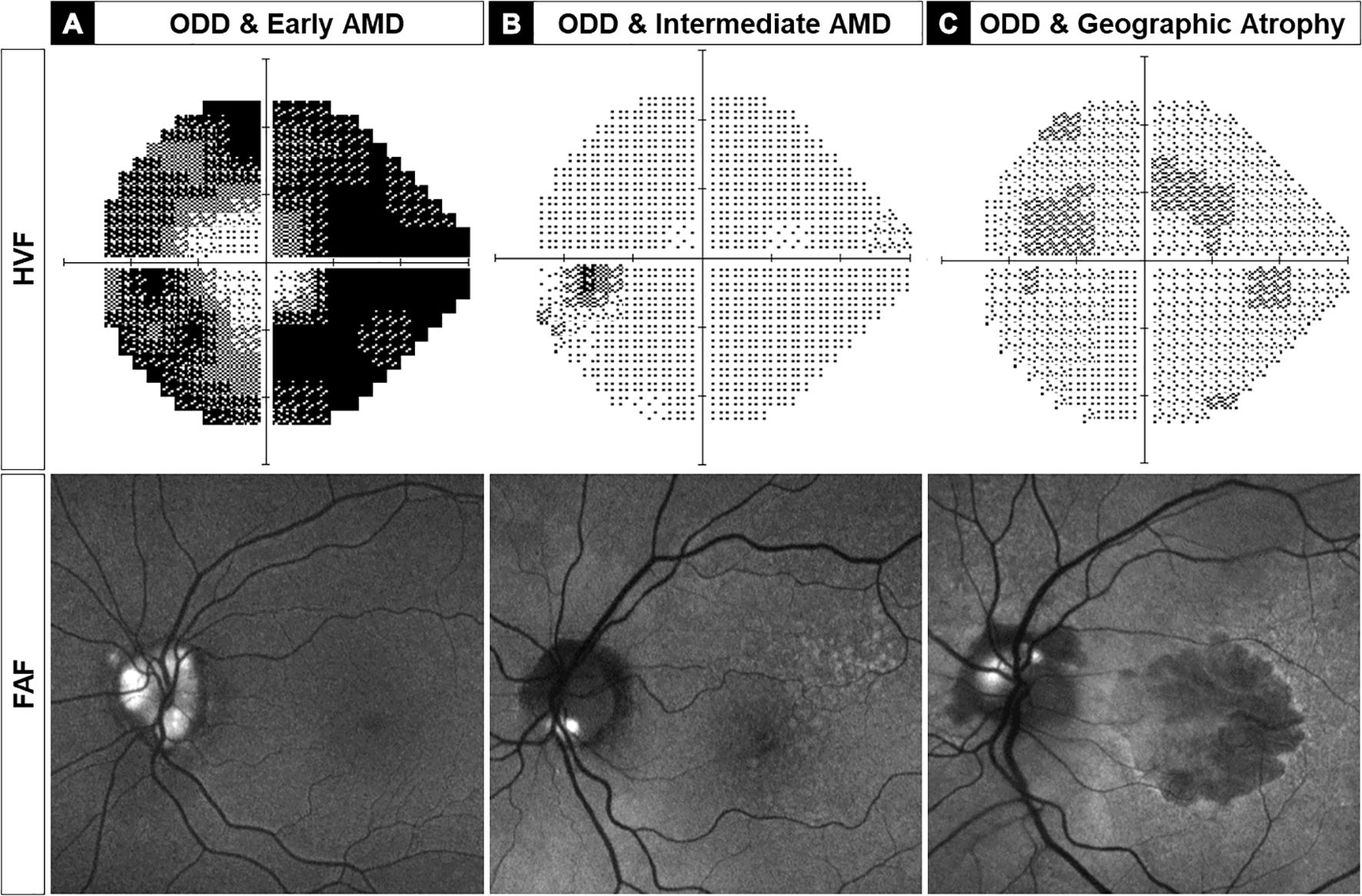 Visual field analysis images and fundus autofluorescence (FAF) maps illustrating different stages of optic disc drusen (ODD) and age-related macular degeneration (AMD). Panel A shows ODD with early AMD, Panel B shows ODD with intermediate AMD, and Panel C shows ODD with geographic atrophy. The top row includes Humphrey visual field (HVF) results, while the bottom row displays corresponding FAF images, highlighting changes in retinal structure and visual function.