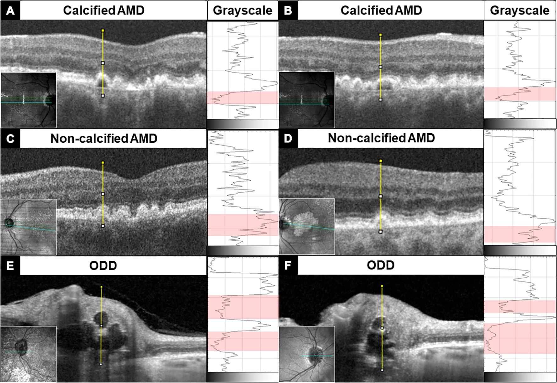 OCT images showing cross-sections of the retina. Panels A and B depict calcified AMD, while C and D show non-calcified AMD. E and F feature optic disc drusen (ODD). Each panel includes a grayscale graph alongside the retinal images, highlighting differences in texture and topography. Inset images display wider views of retinal scans with yellow lines marking specific features.