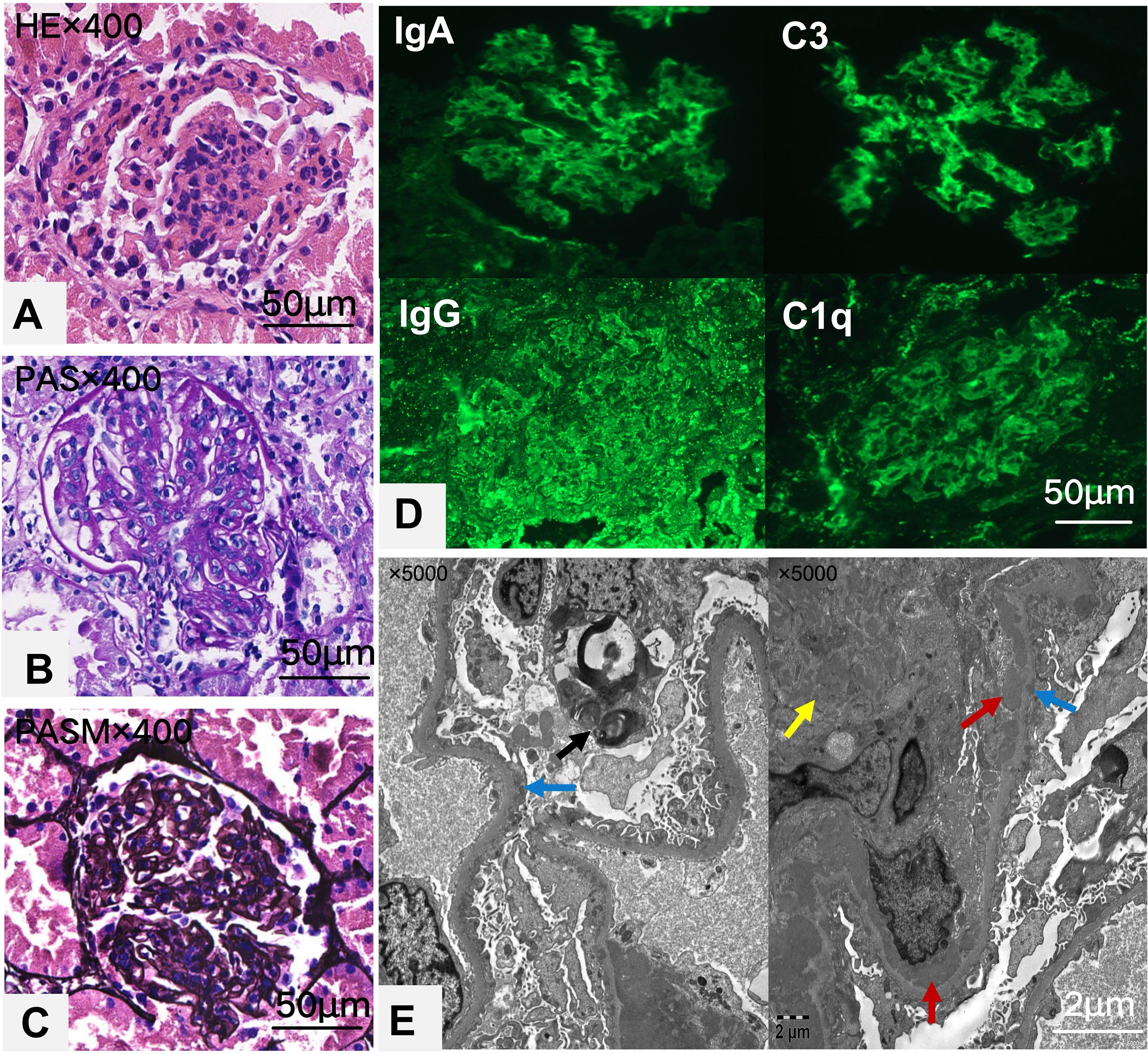 Histological and immunofluorescence images of renal tissue are shown in a series of panels. Panel A shows an H&E stained section, highlighting glomerular inflammation. Panel B displays a PAS stain, enhancing the extracellular matrix details. Panel C shows a PASM stain, showing basement membrane features. Panel D provides immunofluorescence images for IgA, IgG, C3, and C1q, indicating immunoglobulin and complement deposits. Panel E features an electron micrograph with arrows indicating structural details such as podocytes and foot processes. Each image includes a scale bar for size reference.
