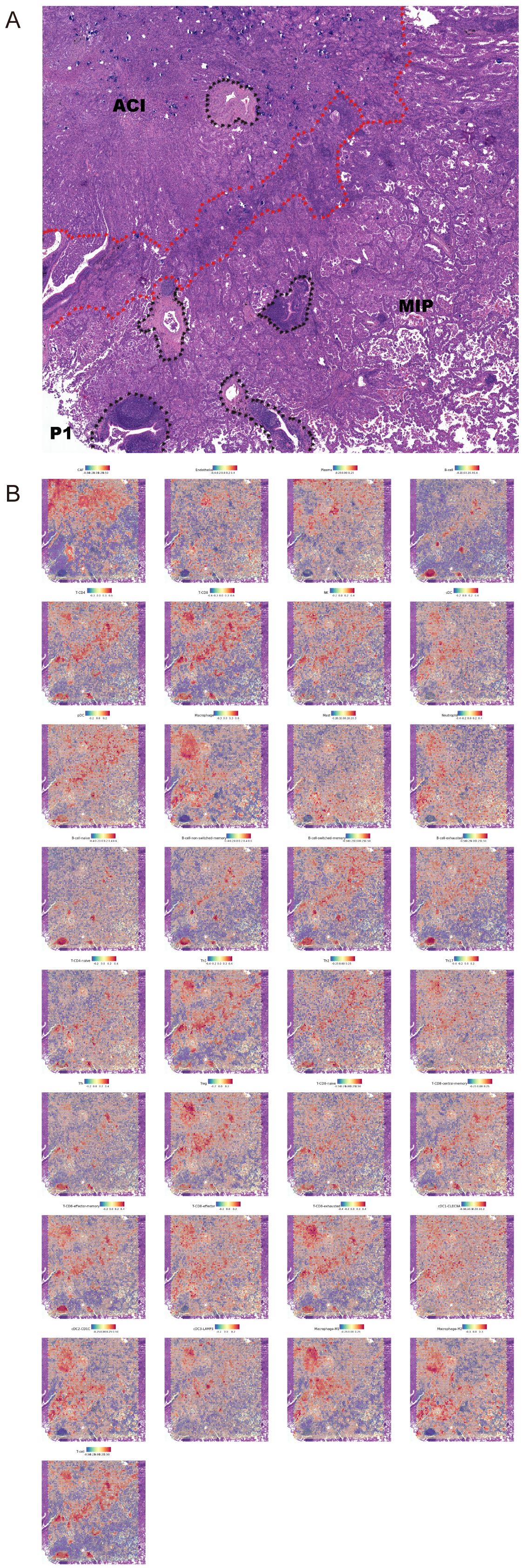Panel A shows a histological section with regions labeled ACI, MIP, and PI, marked with red and black dashed lines. Panel B displays a grid of thirty smaller histological images. Each image has a color gradient bar indicating data values, with variations in red and purple hues, and labels such as ImmRate, and Plasmablasts_2.