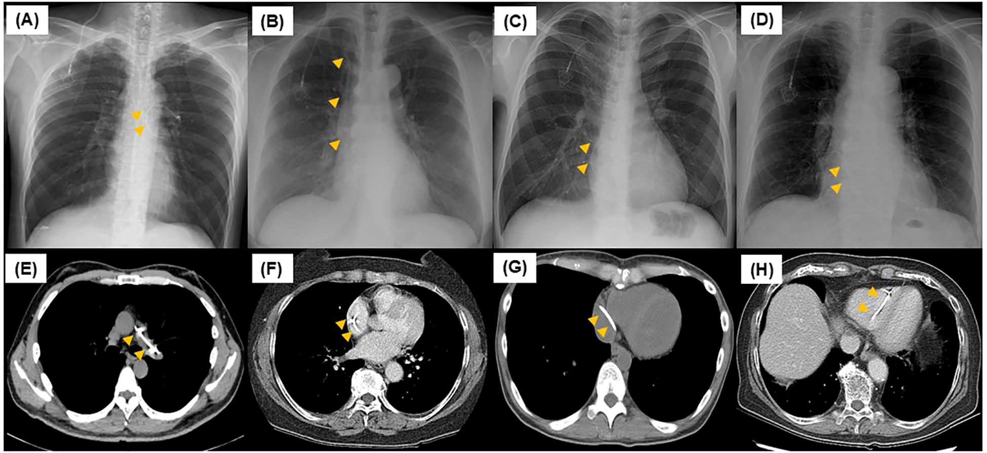 Eight-panel medical imaging study showing chest X-rays and CT scans labeled A to H. Panels A to D display frontal chest X-rays with arrows indicating changes in the mediastinum. Panels E to H show axial CT scans of the chest, with arrows highlighting areas of interest in the mediastinal and cardiac regions.