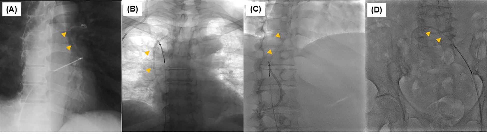 Four-panel medical imaging comparison featuring x-ray images. Panel A: Lateral view of the chest with yellow arrows indicating specific points of interest near the spine. Panel B: Frontal view of the chest showing similar points highlighted by yellow arrows. Panel C: Lateral view of the spine with yellow arrows marking notable features. Panel D: Frontal abdominal x-ray with arrows indicating specific areas, possibly related to catheter placement.