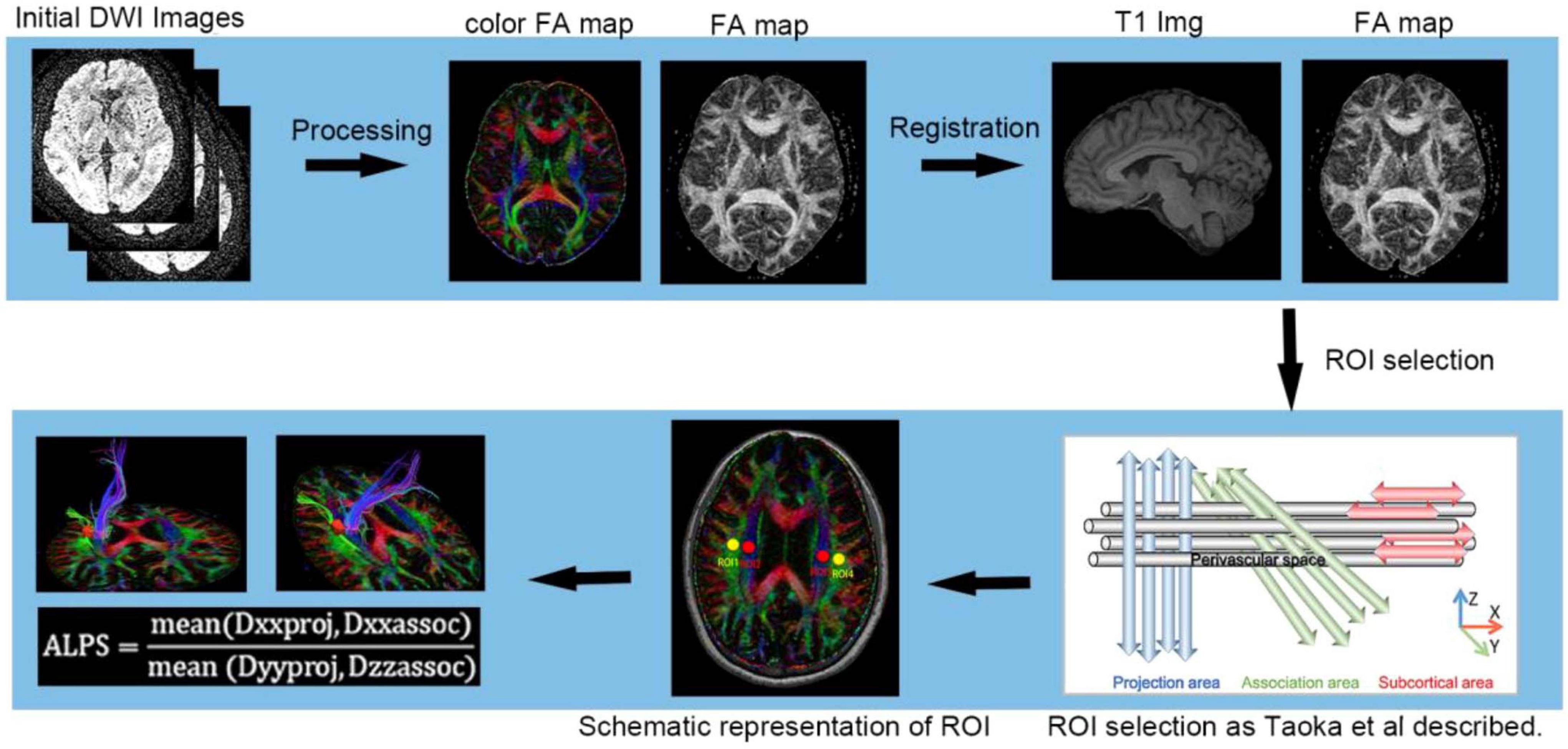Diagram illustrating the process of diffusion-weighted imaging (DWI) analysis. It begins with initial DWI images, followed by processing into a color fractional anisotropy (FA) map, FA map, and T1 image, with registration. ROI selection is performed using a schematic representation as described by Taoka et al. The equation for the ALPS index is shown below the two processed images at the bottom left.