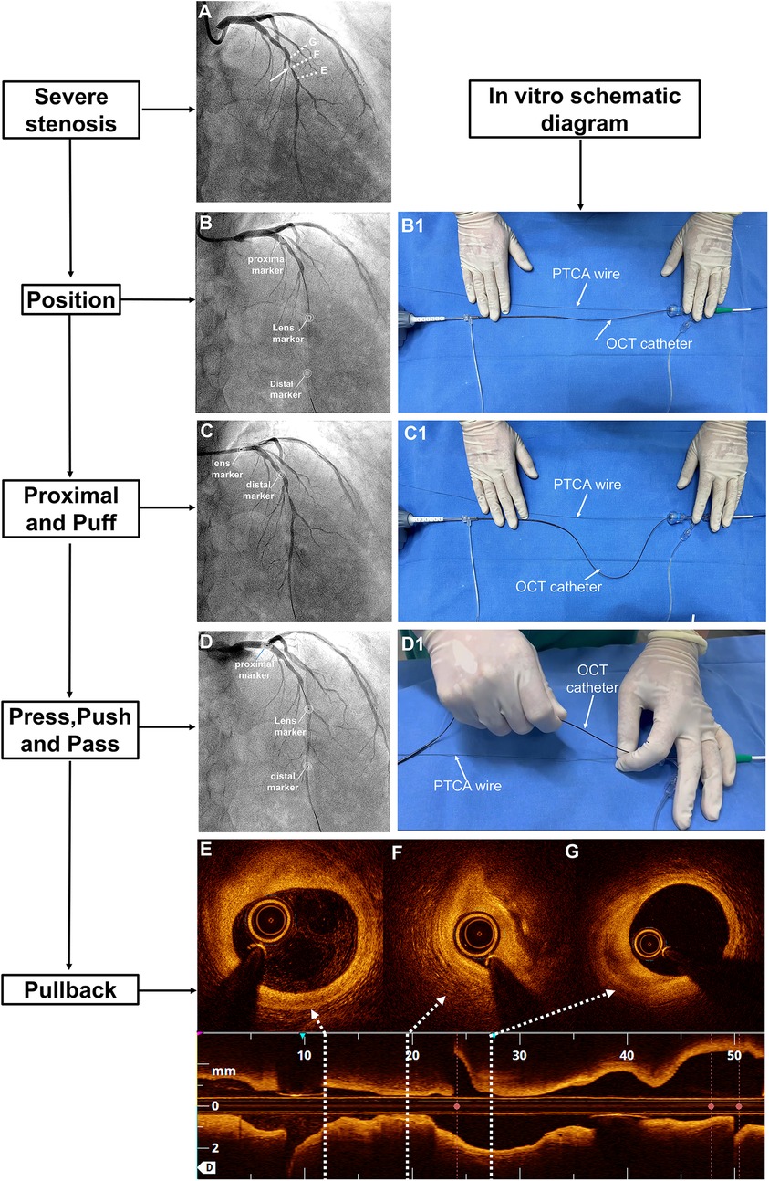 Flowchart illustrating a medical procedure involving coronary angiography and optical coherence tomography (OCT). The left column shows consecutive coronary angiogram images labeled A, B, C, D, indicating steps: severe stenosis, positioning, proximal and puff, and press, push, and pass. The right column shows corresponding in vitro schematic diagrams B1, C1, D1, illustrating catheter placements with labels \