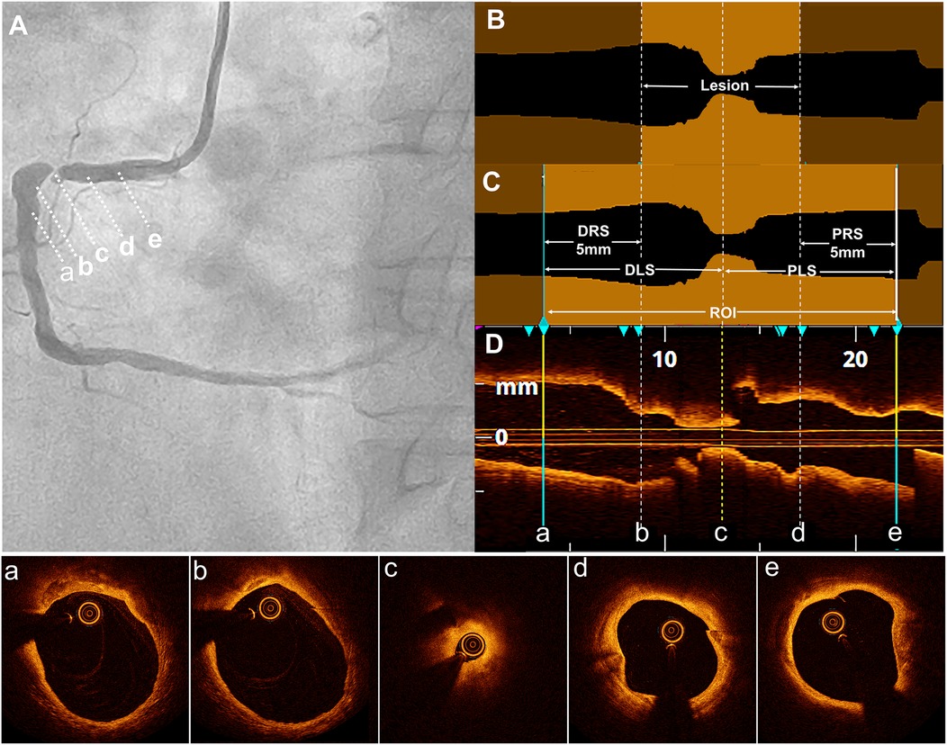 Composite image showing angiography and intravascular imaging. Panel A displays a coronary artery with dashed lines indicating positions a to e. Panel B shows a cross-sectional view of a lesion, and Panel C presents measurements such as DRS, PRS, DLS, PLS, and ROI. Panel D provides a longitudinal section with markers for 0, 10, and 20 mm. Panels a to e illustrate circular cross-sectional images of the artery at specified locations.