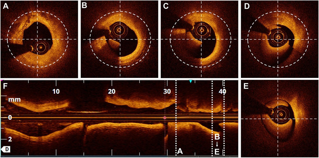 A series of optical coherence tomography (OCT) images illustrating lumen visibility scoring. Panels A to E show cross-sectional vessel images with varying degrees of lumen visibility: from fully visible (4 points) in Panel A to barely visible (0 points) in Panel E. Each panel is annotated with dashed circles or arcs to highlight the proportion of visible circumference. Panel F shows a longitudinal OCT view of the vessel with scale markers and lines indicating segment lengths. This figure supports a semi-quantitative scoring method for assessing lumen clarity in OCT imaging.