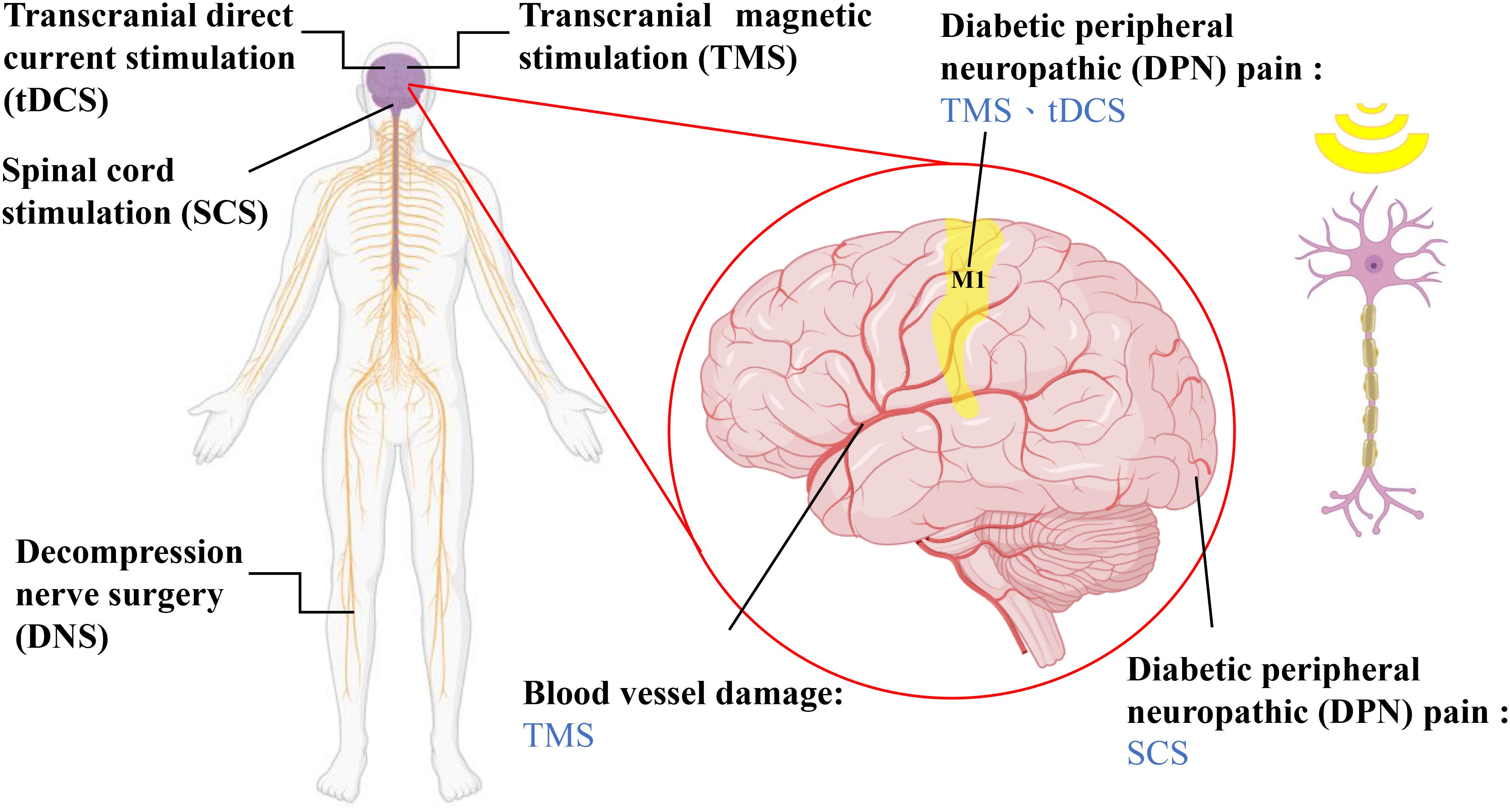 Diagram depicting treatments for diabetic peripheral neuropathic pain, showing a human outline with labels for transcranial direct current stimulation, spinal cord stimulation, and decompression nerve surgery. A brain illustration highlights the M1 area. Labels indicate treatments: TMS and tDCS for diabetic neuropathic pain and blood vessel damage. An adjacent neuron is shown with signaling waves.