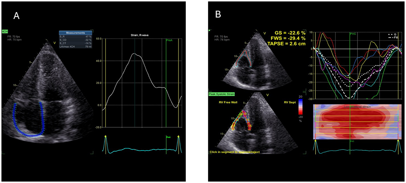 Panel A shows a cardiac ultrasound with a highlighted path and a strain graph indicating heart muscle deformation. Panel B shows two heart images with marked regions and graphs showing cardiac strain measurements. Measurements include GS at -22.6 percent, FWS at -29.4 percent, and TAPSE at 2.6 centimeters.