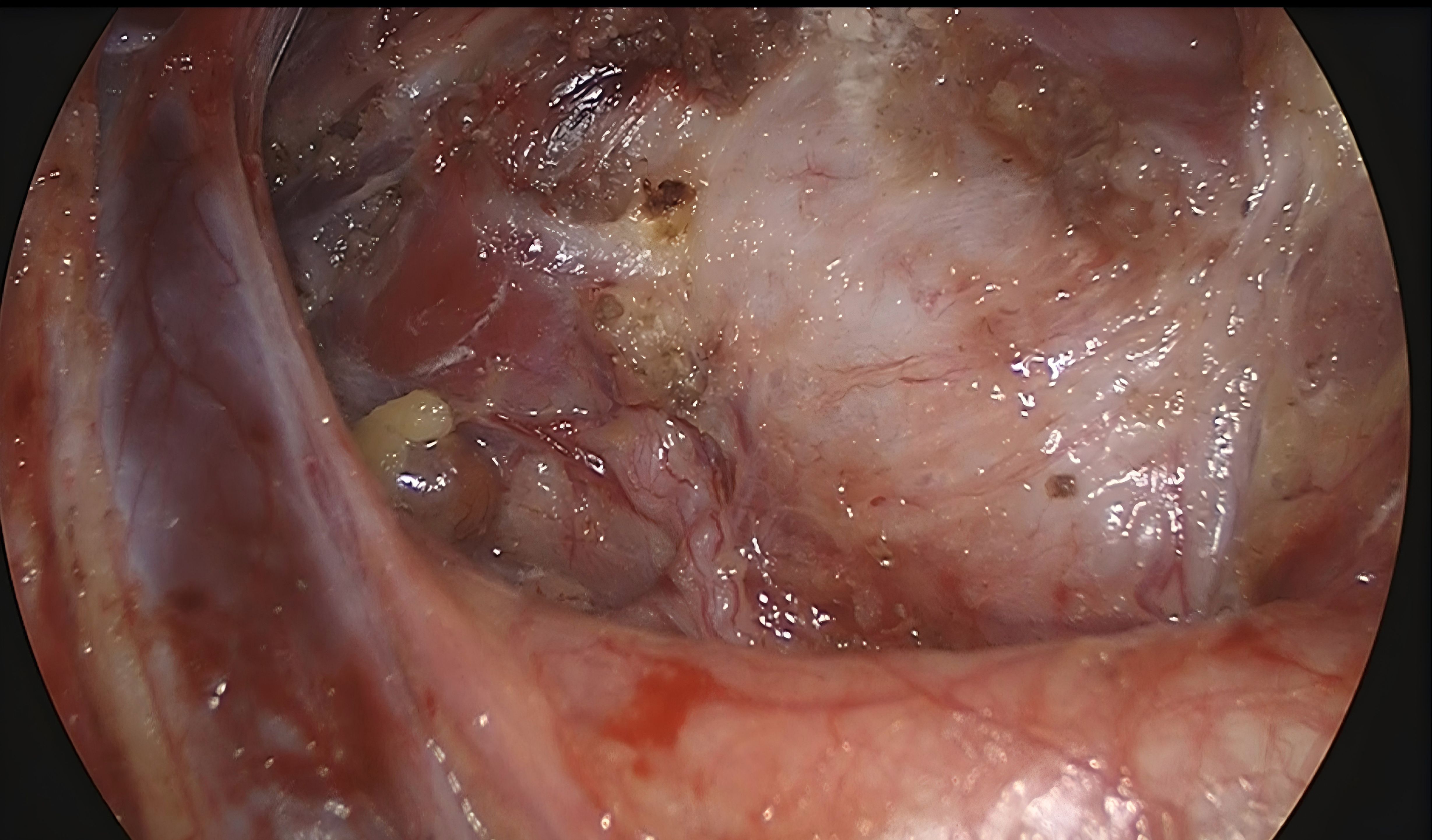 Close-up medical image showing a section of tissue with varying colors and textures, including reddish and whitish areas with visible veins and some darker spots. The image appears to depict an internal view, possibly during a surgical procedure.