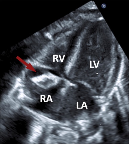 Ultrasound image of the heart showing labeled sections: right ventricle (RV), left ventricle (LV), right atrium (RA), and left atrium (LA). A red arrow points to a right atrial mass.