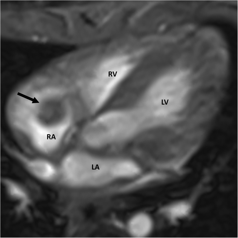 MRI image of a human heart showing labeled chambers: right atrium (RA), right ventricle (RV), left atrium (LA), and left ventricle (LV). An arrow points to a right atrial mass.
