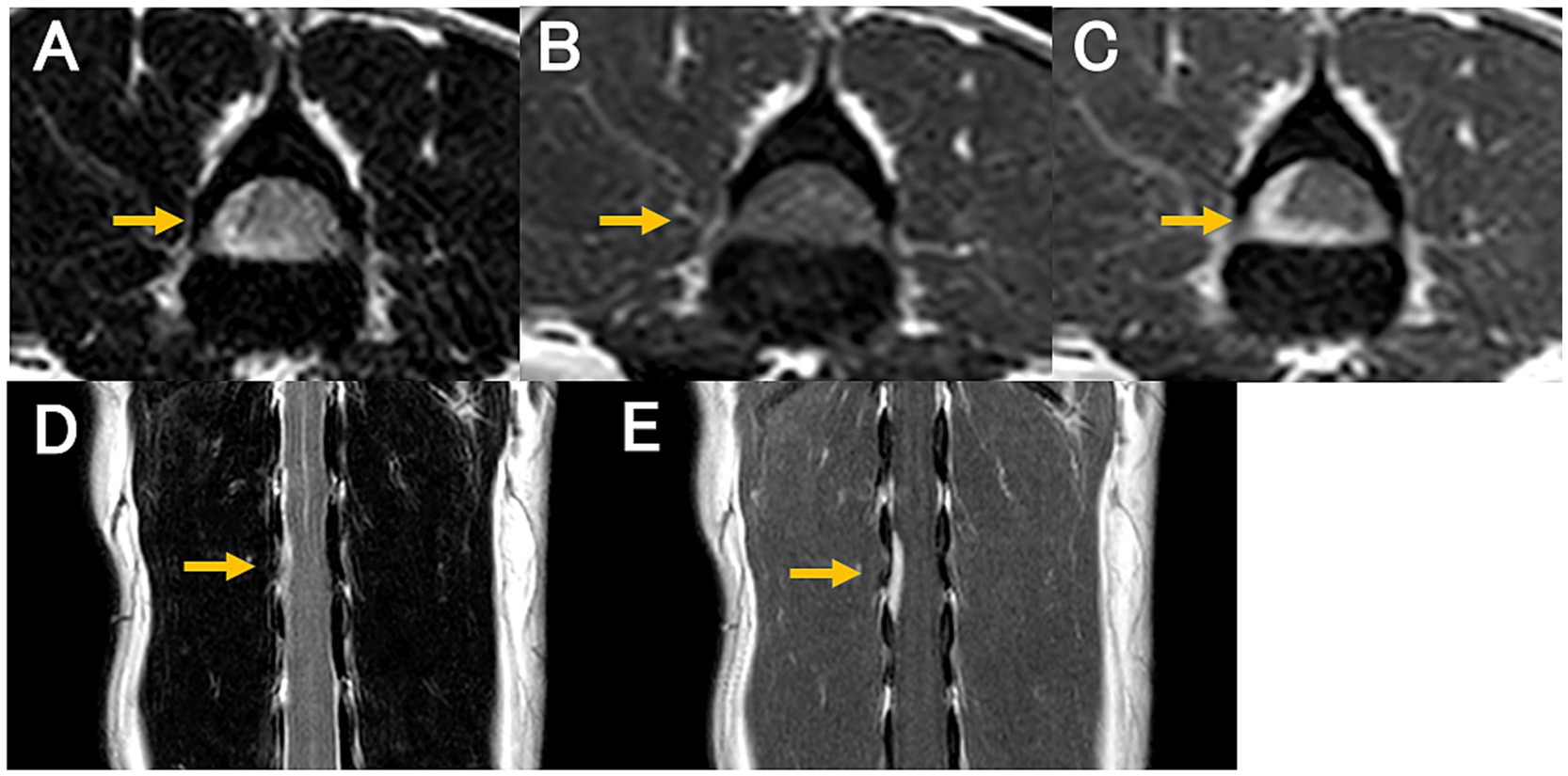 Five MRI images labeled A to E show spinal cross-sections and vertical views of the spinal cord. Yellow arrows point to specific areas of interest, highlighting different aspects of the spine's anatomy or pathology.