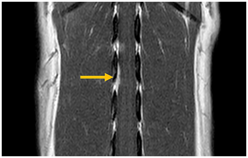 MRI showing a section of the abdomen with a yellow arrow pointing to an area of interest along the spinal column, possibly indicating a medical issue or area for further investigation.