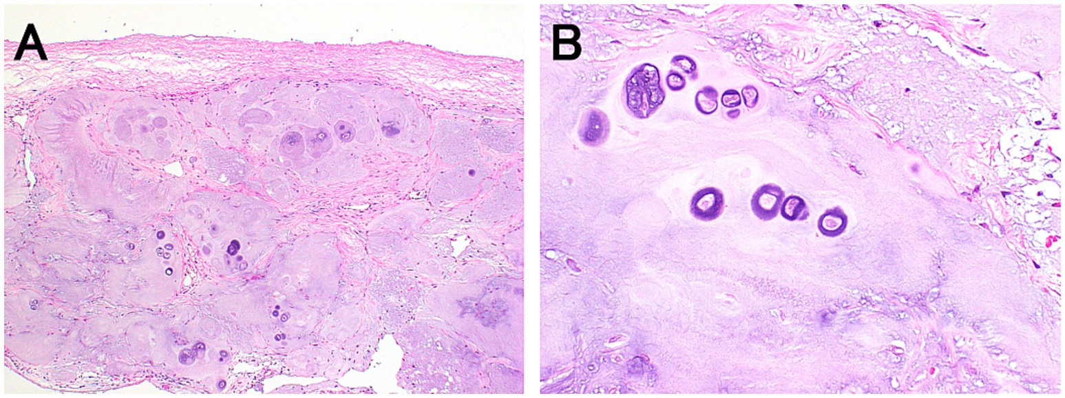 Histological images labeled A and B showing tissue samples stained with hematoxylin and eosin. Panel A displays a general view with large, irregular cell clusters, while Panel B offers a closer view highlighting smaller clusters and darker staining in certain cells, indicating possible areas of interest.