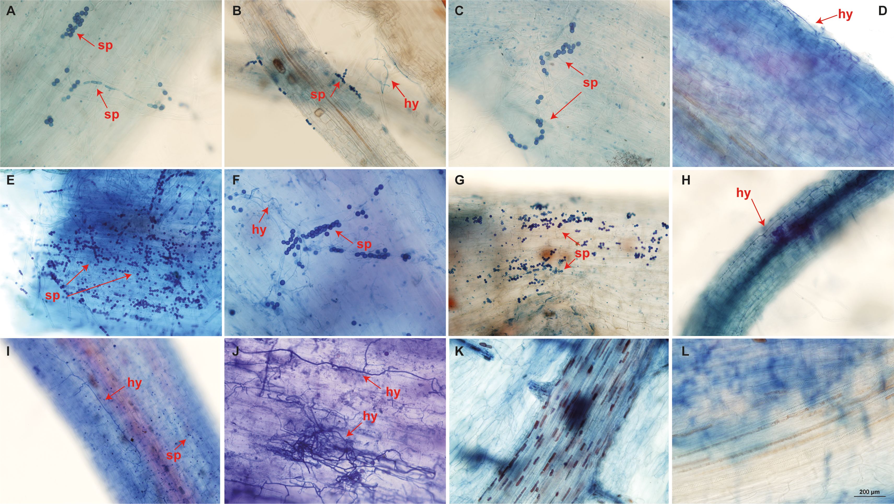 Microscopic images in banana accessions Calcutta 4 and Prata-Anã show fungal structures labeled with “sp” indicating spores and “hy” indicating hyphae following inoculation with Fusarium oxysporum f. sp. cubense STR4. Panels A to L display varying concentrations and arrangements of these structures on root tissues, with blue and purple hues highlighting different areas. Each panel illustrates distinct fungal formations on plant tissues. Some images emphasize clustered spores, while others focus on hyphae presence within the plant cells. A scale bar in the bottom right image measures 200 micrometers.