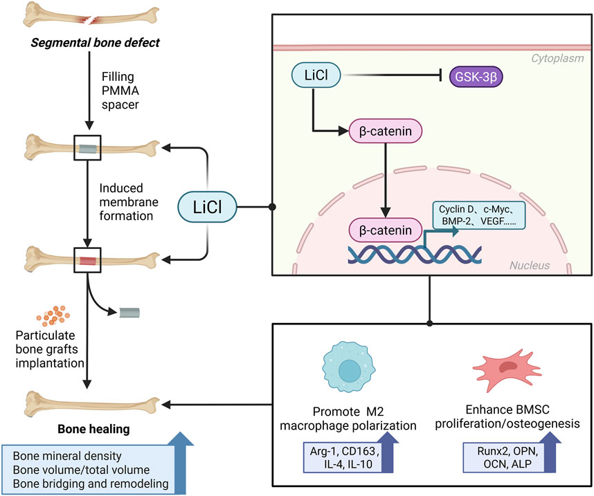 Flowchart illustrating the process of bone healing. It shows a sequence starting with a segmental bone defect, followed by filling with a PMMA spacer and induced membrane formation using LiCl. The cytoplasmic interaction involves LiCl inhibiting GSK-3β, leading to β-catenin activation. In the nucleus, this activation promotes the expression of Cyclin D, c-Myc, BMP-2, and VEGF. The diagram ends with bone healing, enhanced through M2 macrophage polarization and BMSC proliferation/osteogenesis, improving bone mineral density, volume, and remodeling.