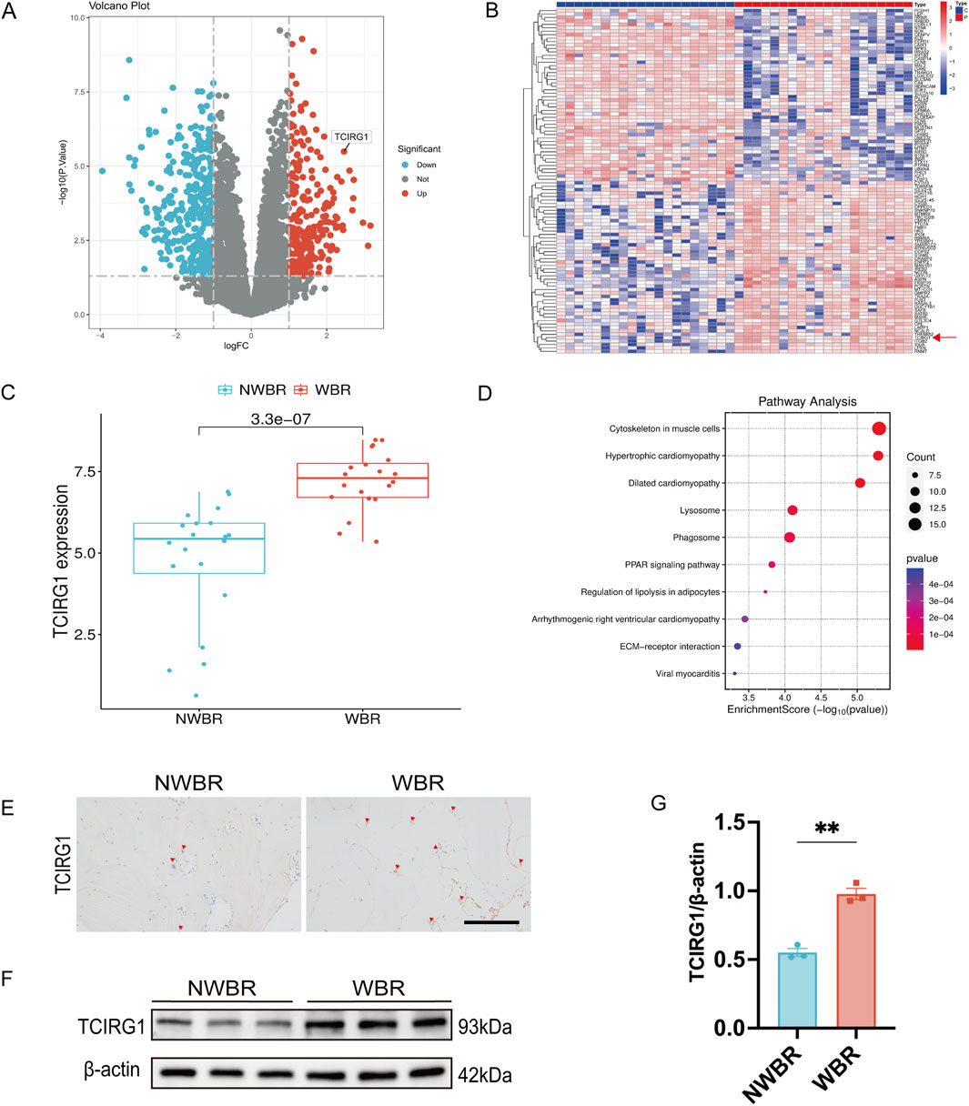 Panel A shows a volcano plot indicating TCIRG1 expression with significant upregulated and downregulated genes. Panel B depicts a heatmap of gene expression profiles with clustering. Panel C has a box plot comparing TCIRG1 expression levels between NWBR and WBR, showing higher expression in WBR with a significant p-value. Panel D illustrates pathway analysis with various pathways plotted against enrichment scores. Panel E includes images of TCIRG1 expression in NWBR and WBR tissues. Panel F displays Western blot results showing TCIRG1 and β-actin bands for NWBR and WBR. Panel G presents a bar graph comparing TCIRG1/β-actin ratios, significantly higher in WBR.