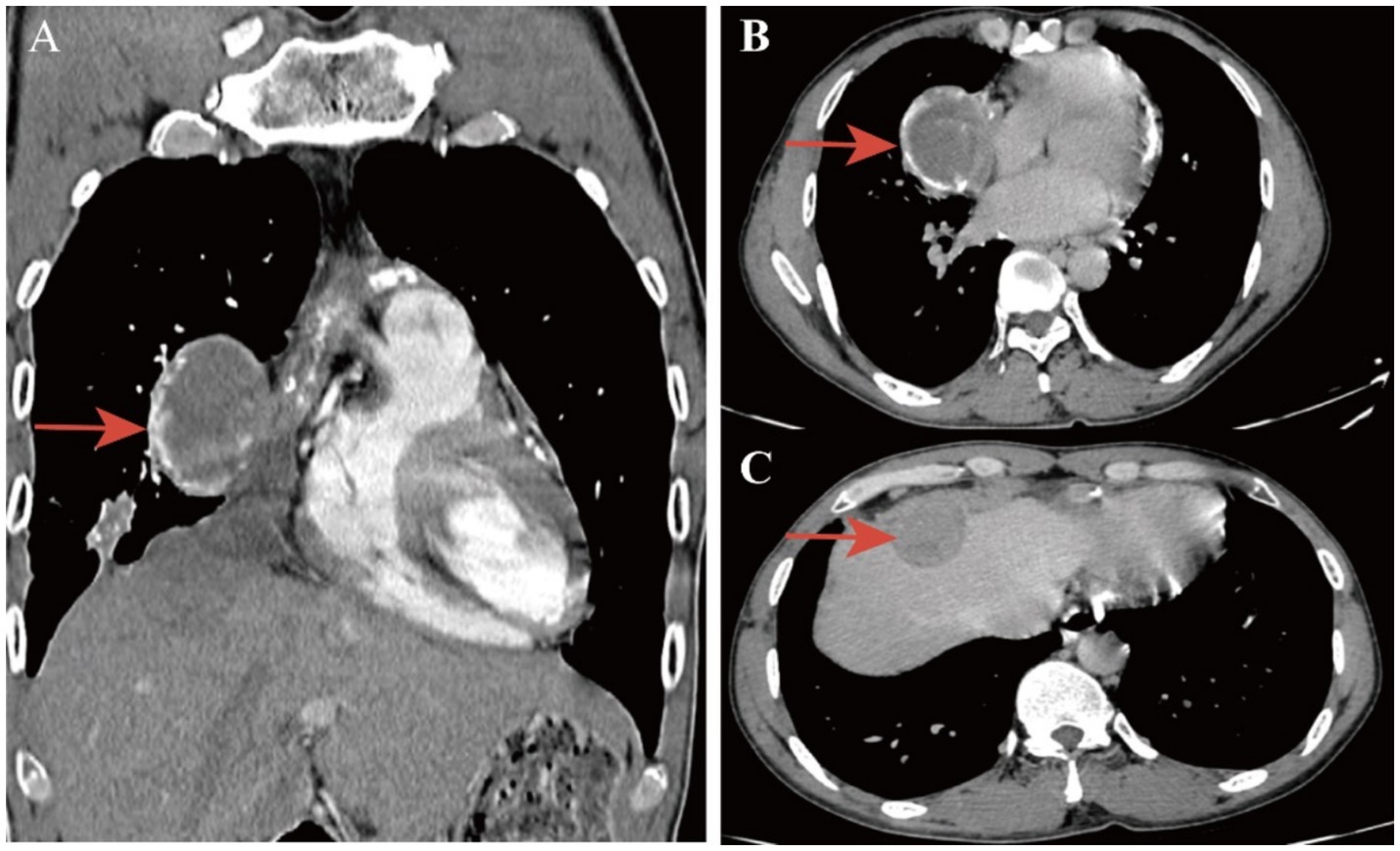 Three medical imaging scans labeled A, B, and C. Image A shows a coronal scan highlighting a large mass in the left thorax. Image B is an axial scan focusing on the same mass near the heart. Image C shows another axial scan with a mass in the abdominal area near the liver. Red arrows indicate the locations of the masses in each image.