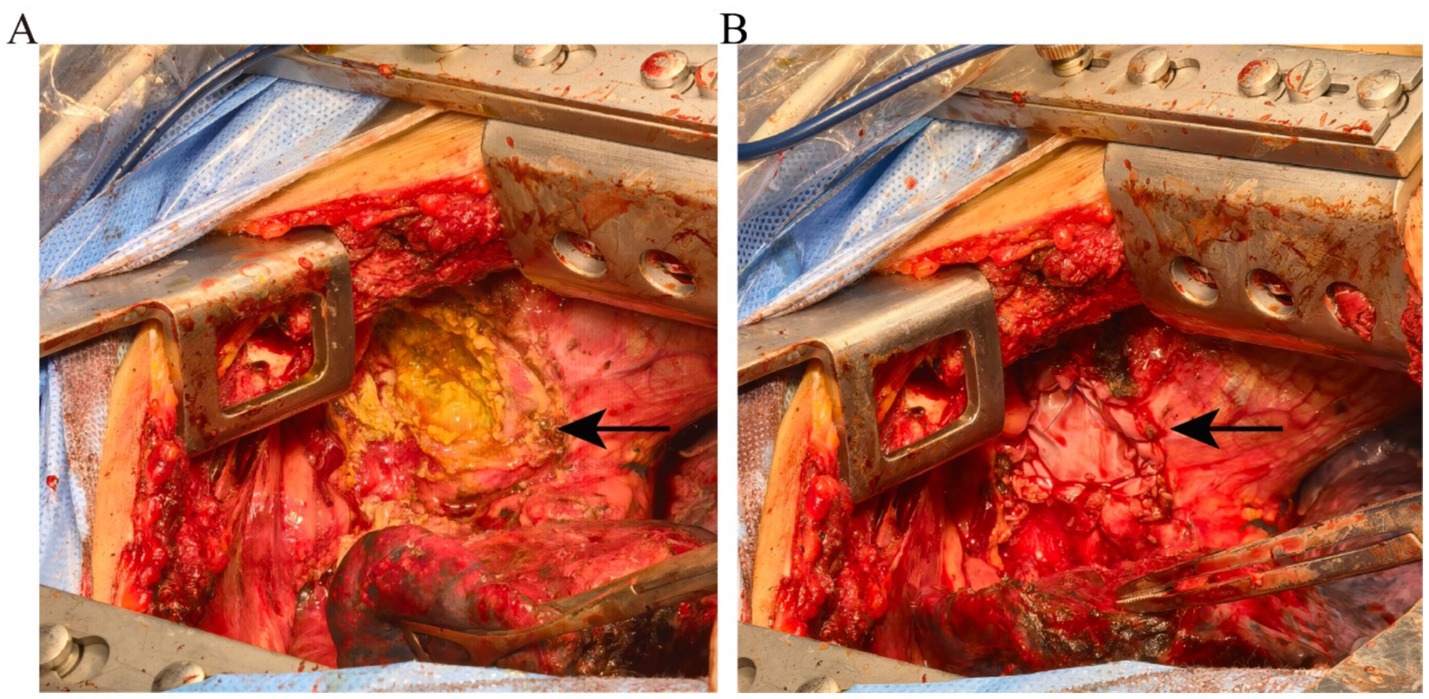 Panel A shows a surgical site with exposed tissue displaying yellowish areas, highlighted by an arrow. Panel B shows the same site with additional cleaning or modification, where the yellow tissue is replaced by more red and pink areas, also marked by an arrow.