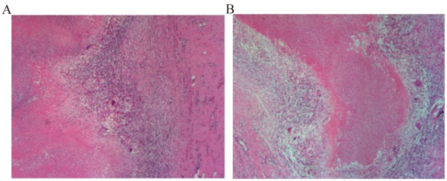 Histological images labeled A and B show tissue samples under a microscope. Both images display varying shades of pink and purple, indicating different cellular structures and densities. Image A has a more diffuse pattern, while image B shows a denser, circular formation.