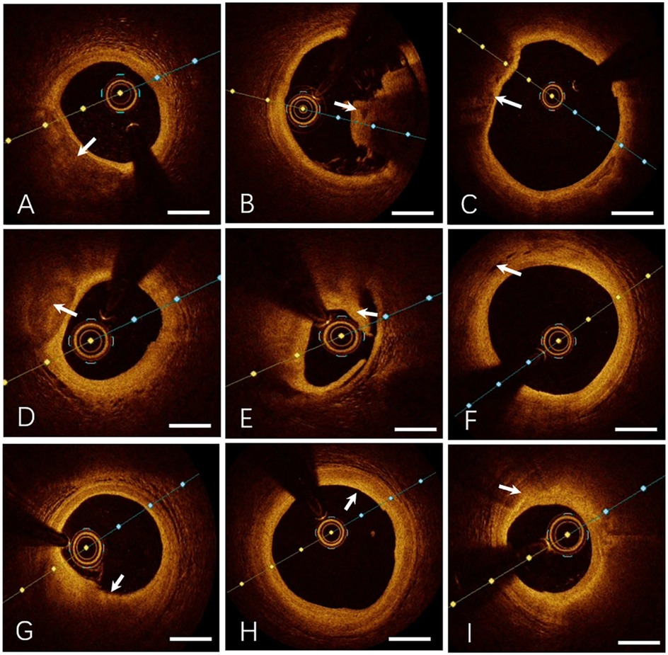 Nine-panel image of cross-sectional views from optical coherence tomography scans of a vessel. Each panel, labeled A to I, shows varying degrees of plaque buildup indicated by arrows. Color-coded lines and markers are used for alignment and measurements. The variations highlight different plaque formations and vessel shapes. Scalebars are included for reference.