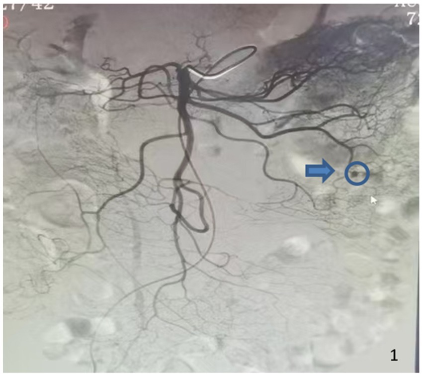 Angiographic image displaying a network of blood vessels. A prominent dark vessel extends diagonally, with smaller branches radiating. A blue arrow points to a specific location within the network, highlighted by a blue circle.