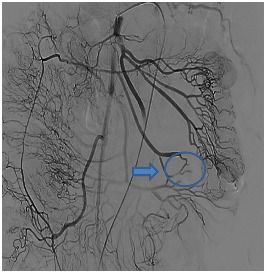 Angiogram showing detailed view of blood vessels, with an arrow pointing to a circled area highlighting a specific section of the vascular structure. Blood vessels are clearly visible and intertwined.