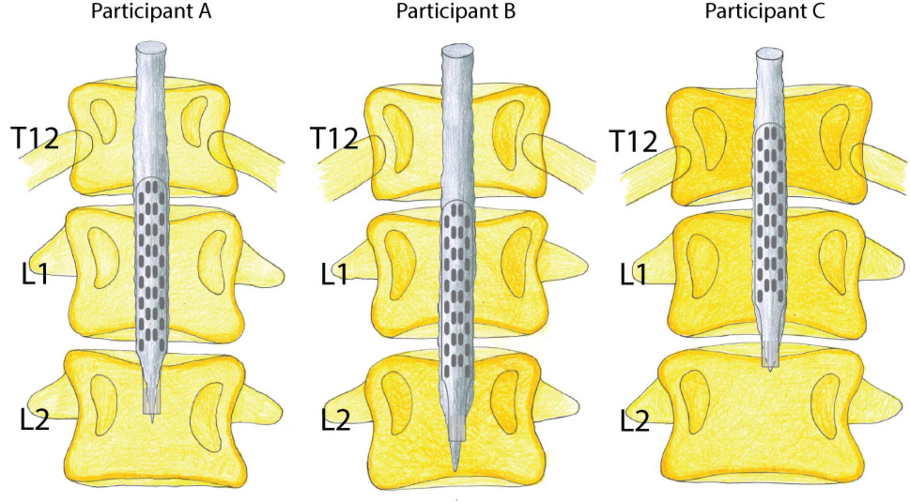 Illustration showing spinal column segments T12, L1, and L2 for Participants A, B, and C. Each segment includes a vertical rod implanted through the vertebrae. The rod is depicted with perforations along its length.