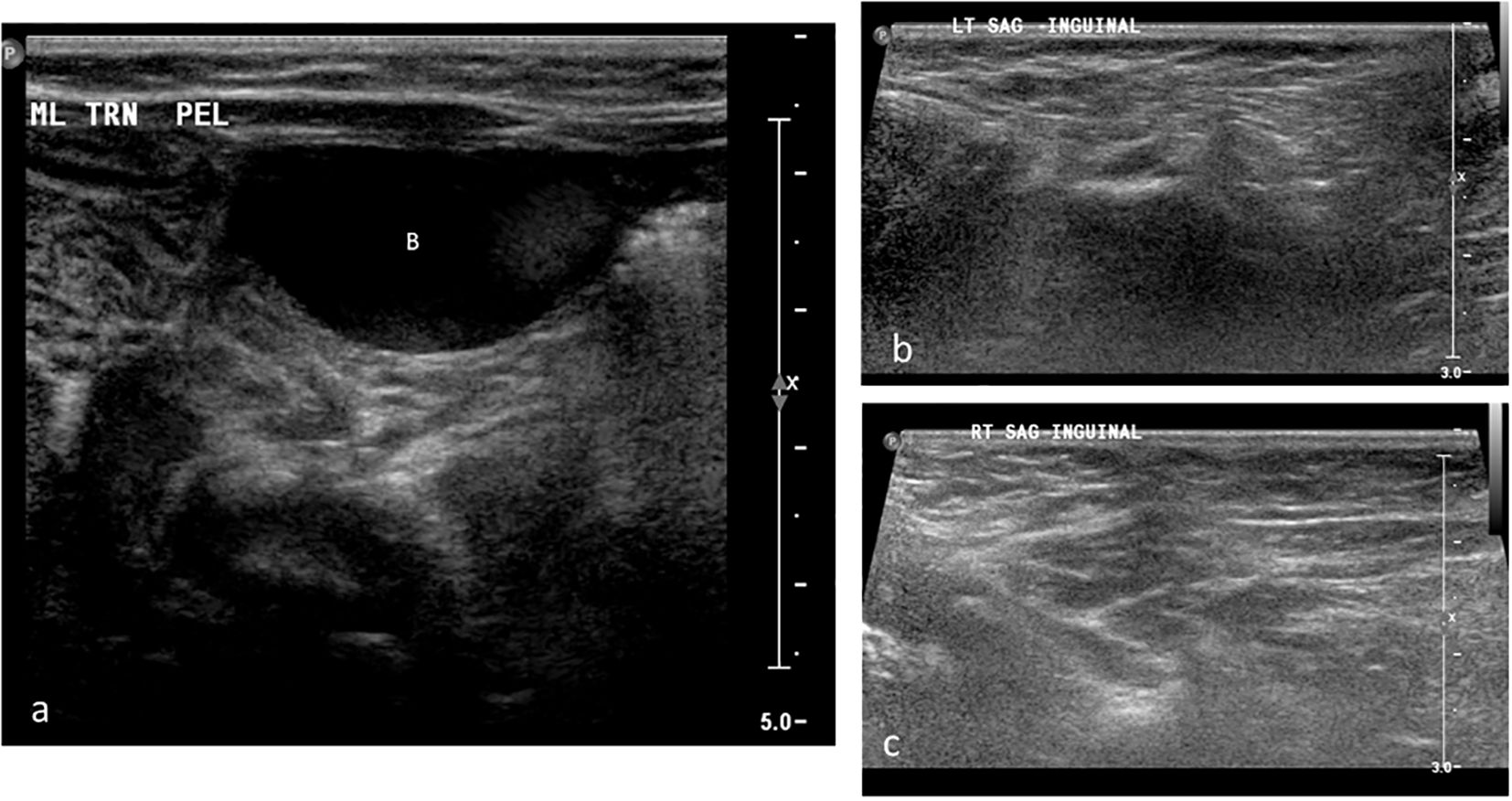 Ultrasound images showing different images. Image “a” displays a transverse pelvic area with a dark, circular section marking the urinary bladder. Images “b” and “c” show sagittal scans of the left and right inguinal regions demonstrating absence of gonadal tissue.
