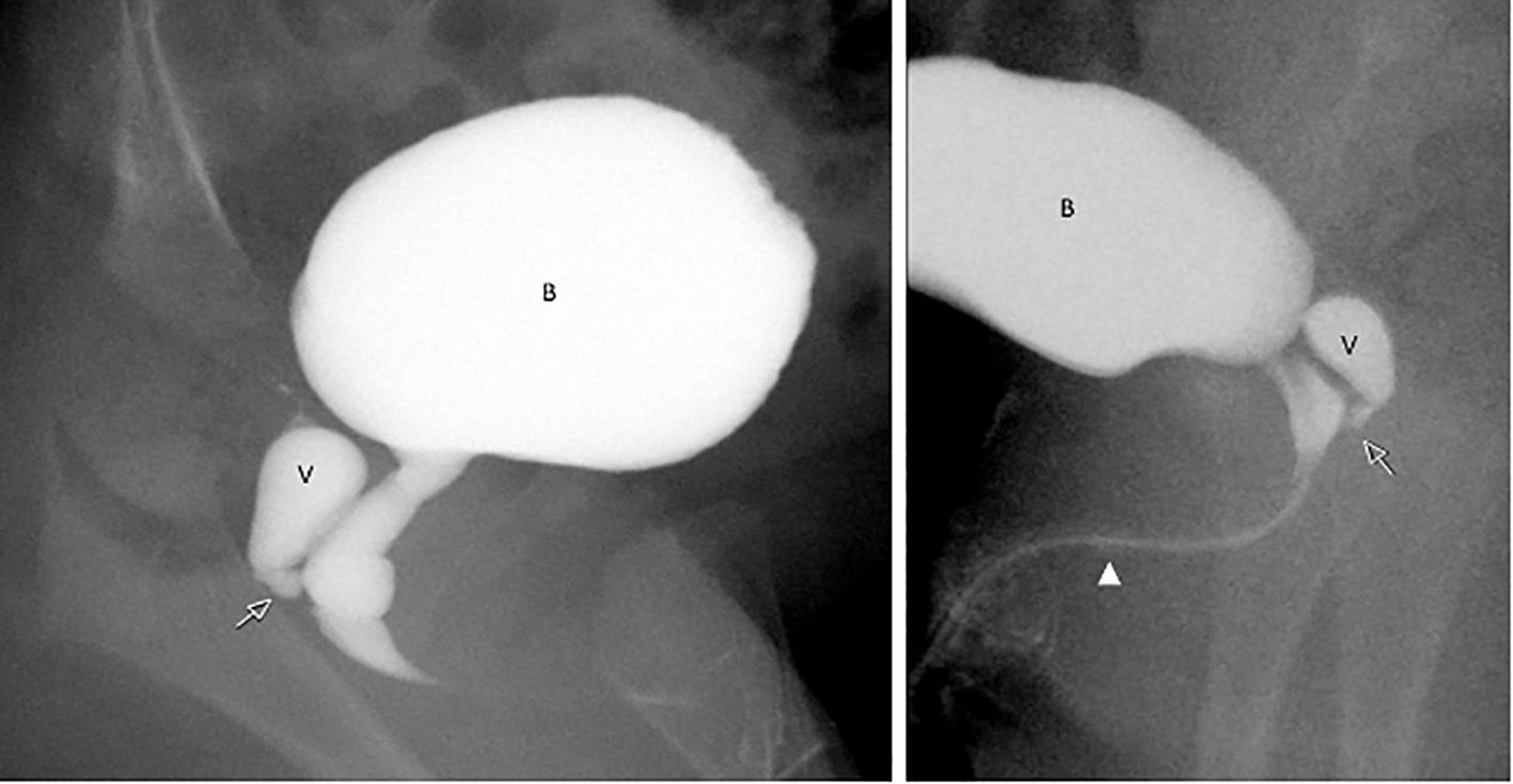 Catheter genitogram images from Patient 1 illustrating internal urogenital anatomy, vaginal remnant (labeled V) posterior to the urinary bladder (labeled B), joining the elongated urethra at the level of the urogenital sinus (arrow).