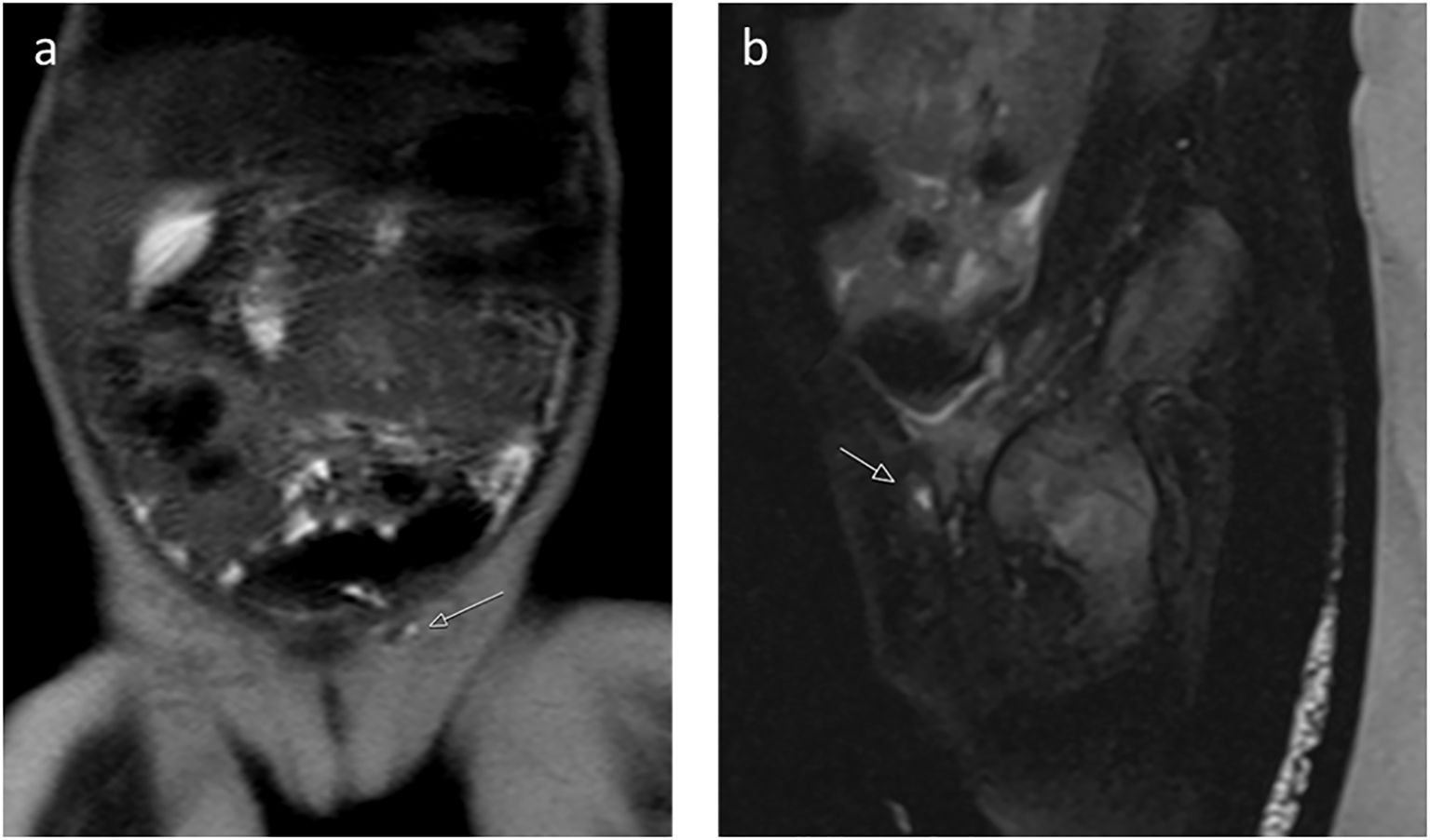 MRI images show two different views of the pelvic region, labeled “a” and “b” Both images have arrows highlighting undescended gonadal tissue, and showing a male-type urethra with a small vaginal-like structure connecting to the urogenital sinus.