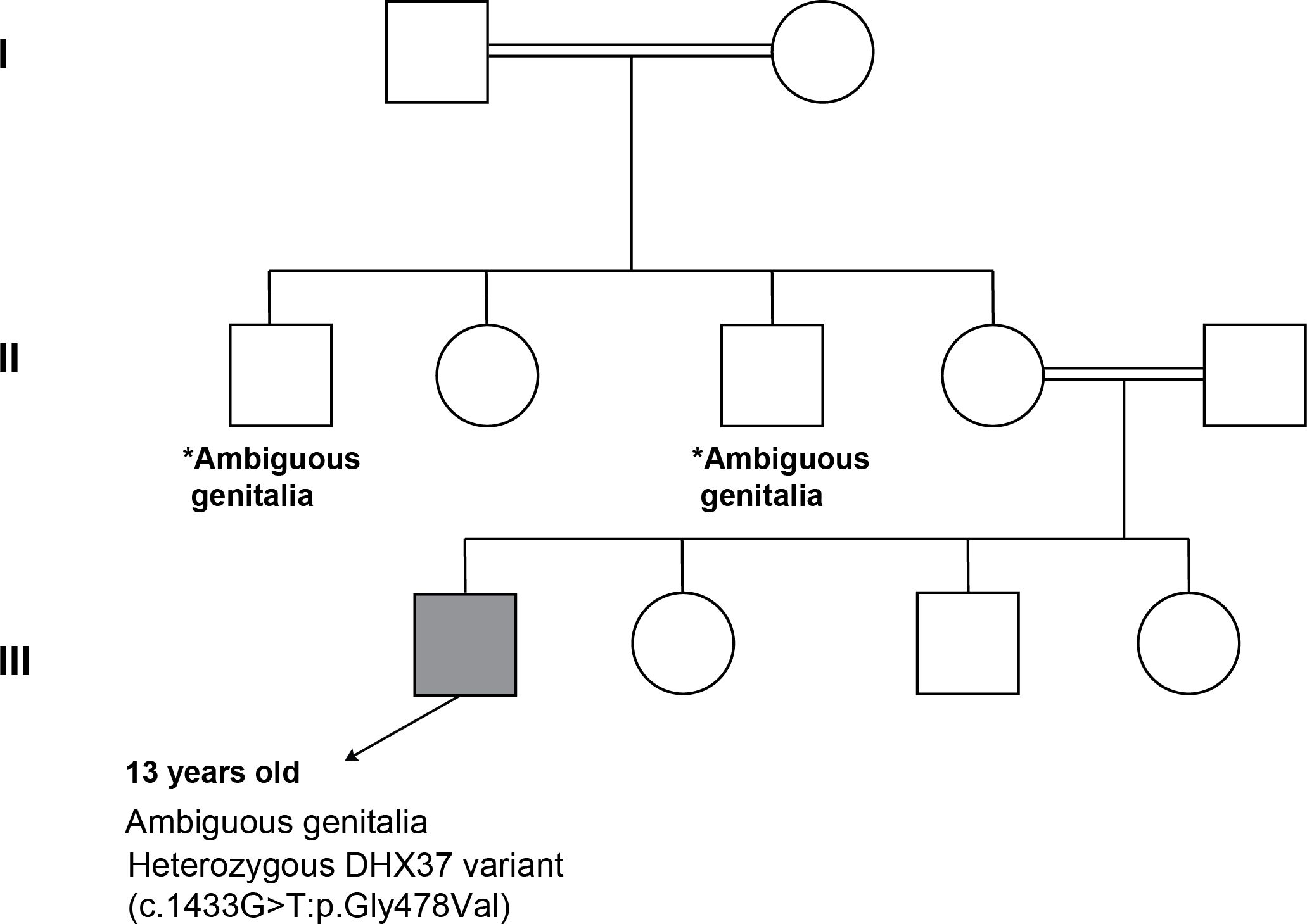 Pedigree chart showing three generations. Generation I includes two related individuals. Generation II has four, with two marked “ambiguous genitalia” one of the females married to a relative leading to Generation III, that has four individuals, one shaded square marking patint 3 with a genetic variant.