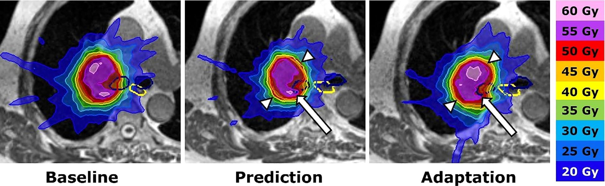 Three-panel medical image showing CT scans with colored overlays indicating radiation doses in gray units (Gy) ranging from 20 to 60. The panels are labeled Baseline, Prediction, and Adaptation. Each panel displays varying levels of radiation coverage, depicted by color gradients from blue to pink. Arrows highlight target areas in the Prediction and Adaptation panels. A color scale on the right provides dose values.