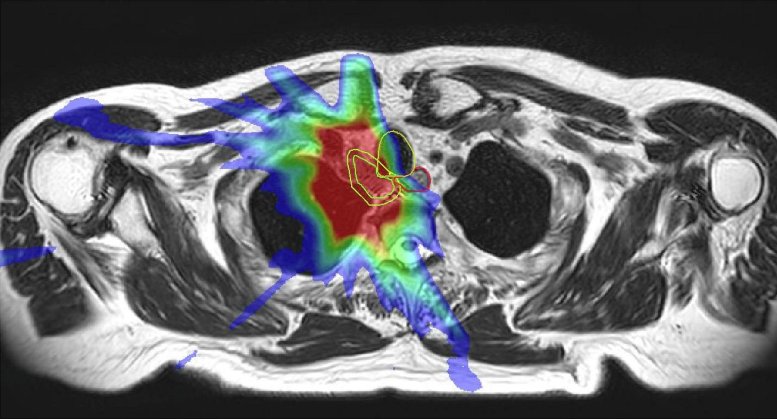 Cross-sectional MRI scan of the chest showing a colored overlay. The overlay consists of red, green, and blue areas, indicating different regions of interest, with circular outlines in red and yellow in the center.