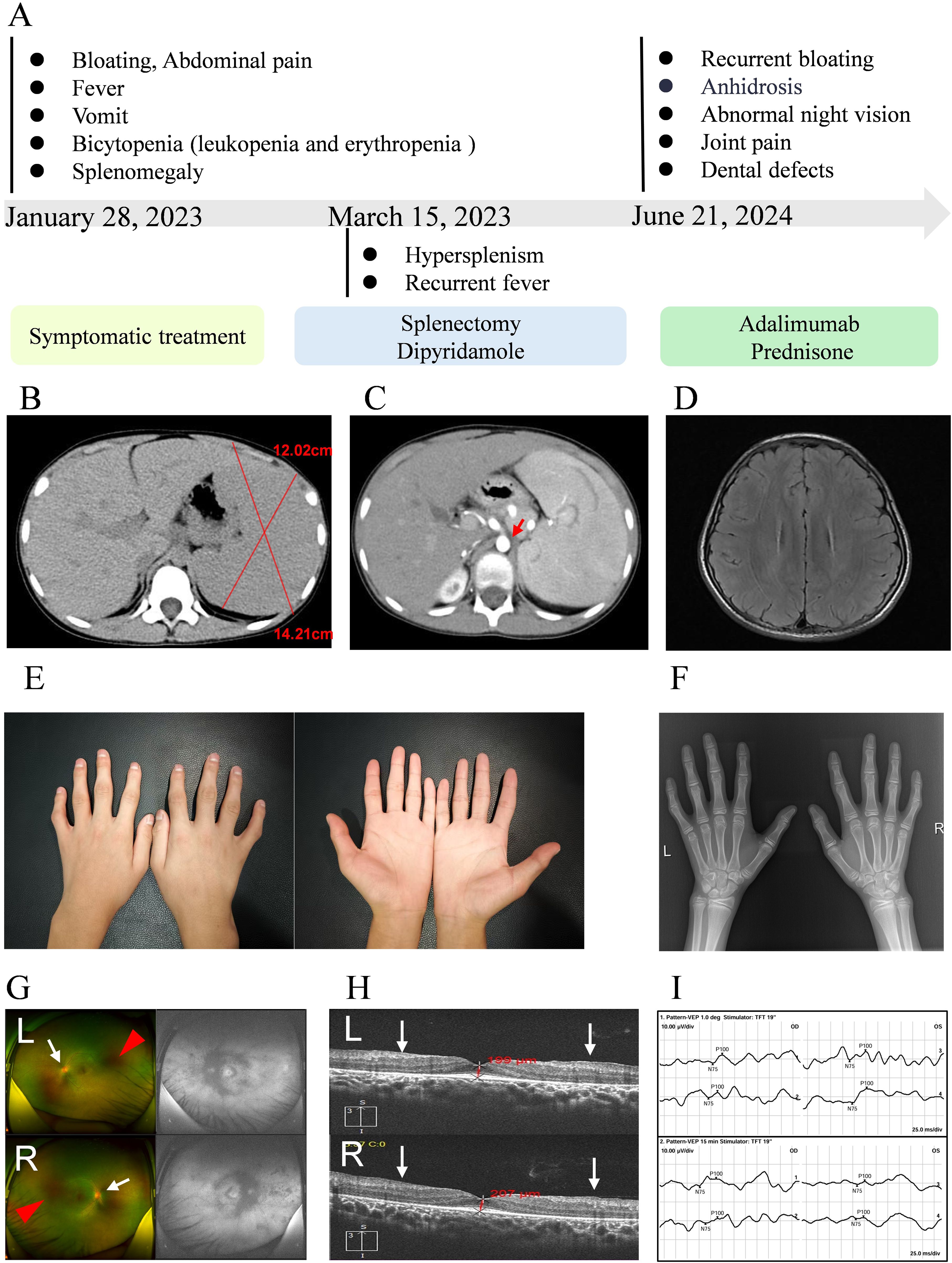 A composite image with the following elements: A) A timeline with medical events and treatments from January 28, 2023, to June 21, 2024, detailing symptoms like bloating and abdominal pain, highlighting treatments such as splenectomy and medications. B) Abdominal CT scan showing splenomegaly. C) Abdominal CT scan with a focus on dilation of the celiac trunk indicated by an arrow. D) Brain MRI scan. E) Photos of hands, front and back, indicating joint appearance. F) X-ray of hands showing bone structure. G) Retinal images with markers indicating areas of interest. H) Optical coherence tomography showing retinal layers with annotations. I) Graphs illustrating visual function test results.