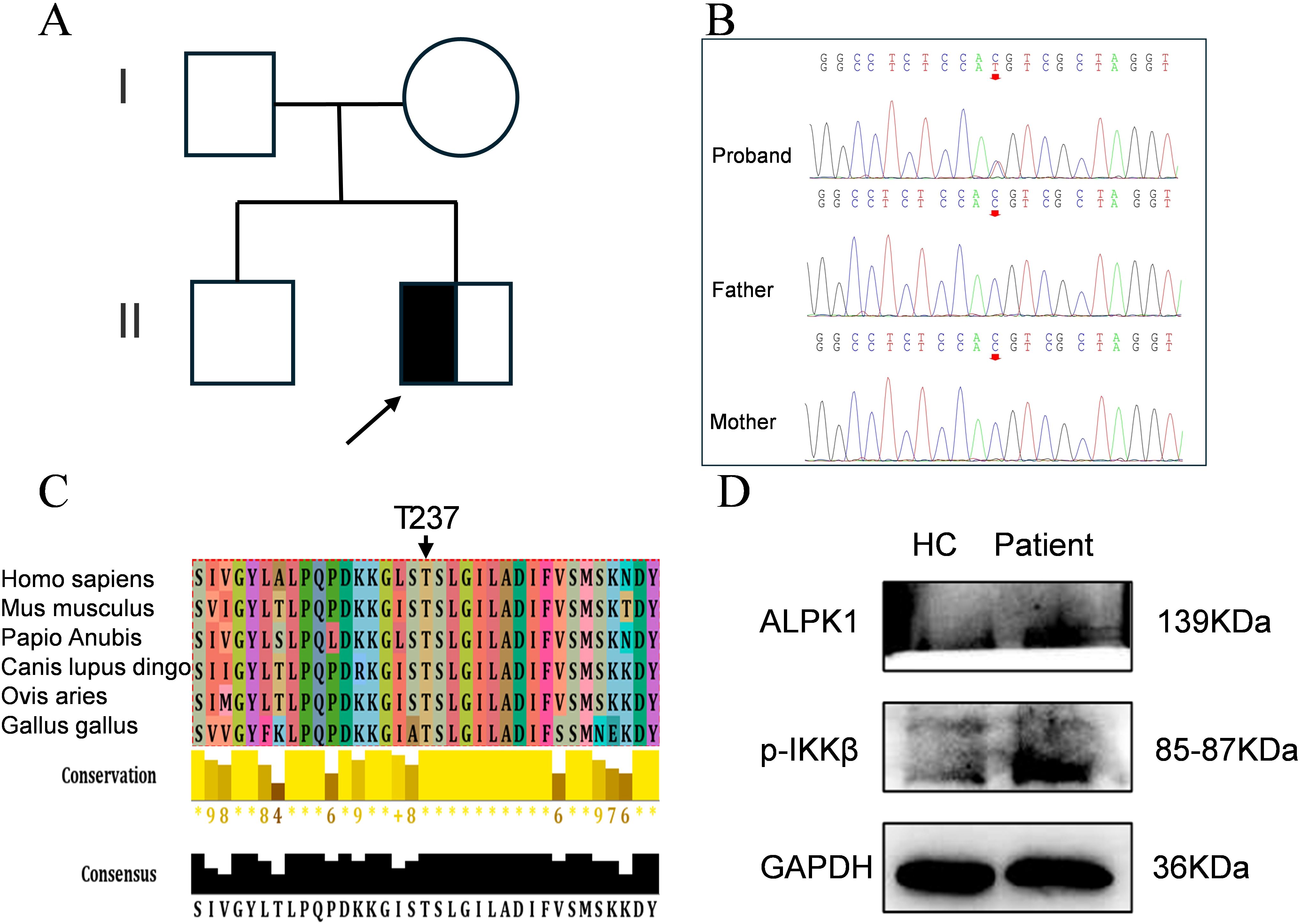 Diagram highlighting genetic analysis in four panels. Panel A shows a family pedigree with one affected individual. Panel B presents DNA sequencing chromatograms for a proband and parents. Panel C illustrates protein sequence alignment across species with a highlighted position, T237. Panel D depicts Western blot results for ALPK1, p-IKKβ, and GAPDH, comparing a healthy control and patient.