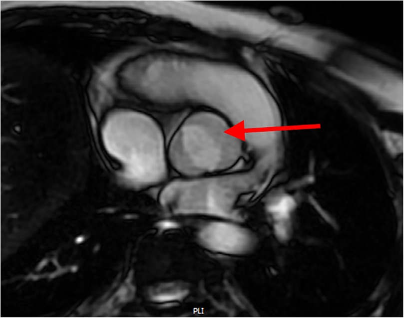 MRI scan showing a cross-section of the aortic valve. A red arrow points to the characteristic fusion between the right and left coronary cusps, typical of a bicuspid aortic valve.