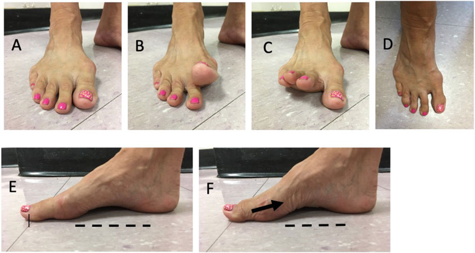Images A to D show a foot from various angles, illustrating a bunion on the big toe. The nails are painted pink. Image E shows the foot in a side view with a line indicating the toe's alignment. Image F also shows a side view with an arrow indicating pressure or direction on the toe.