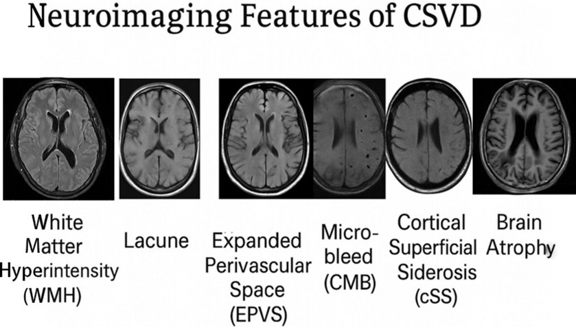Neuroimaging features of cerebral small vessel disease (CSVD) are shown in five MRI scans. These include white matter hyperintensity (WMH), lacune, expanded perivascular space (EPVS), microbleed (CMB), cortical superficial siderosis (cSS), and brain atrophy. Each scan depicts different abnormalities associated with CSVD.