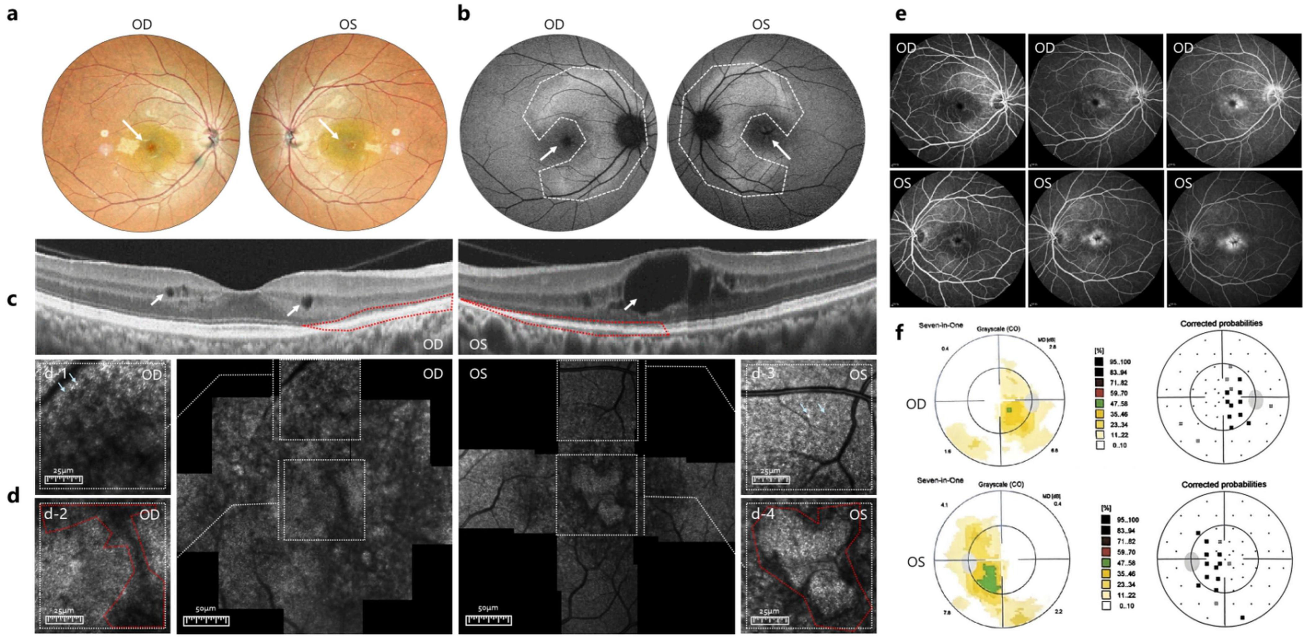 A series of medical images related to eye examinations, including: (a) colored retinal images labeled OD (right eye) and OS (left eye), showing highlighted areas, (b) grayscale vascular images with marked lines, (c) cross-sectional optical coherence tomography scans with arrows indicating features, (d) close-up images with detailed annotations, (e) several angiography images displaying different stages, and (f) probability maps highlighting regions with percentages and labels for each eye.