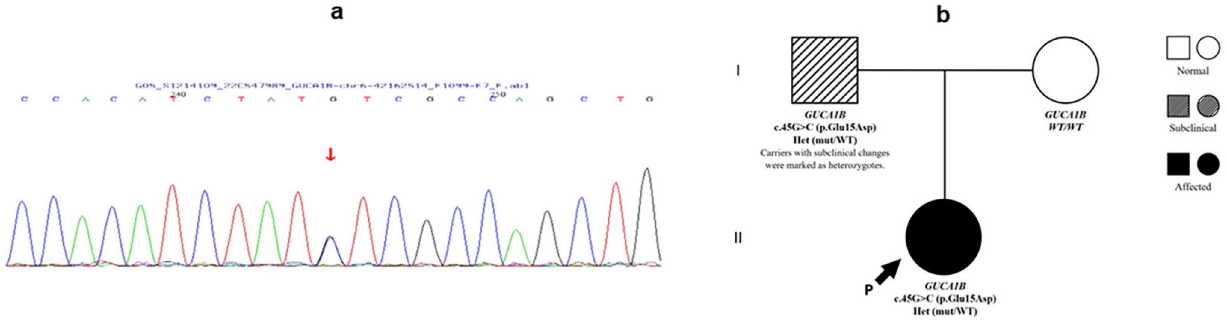 Panel a shows a DNA sequencing chromatogram with colored peaks representing nucleotide sequences. A red arrow highlights a specific point of interest. Panel b is a pedigree diagram displaying genetic inheritance, with symbols indicating normal, subclinical, and affected individuals. The proband is marked by an arrow, showing they have the c.45G>C (p.Glu15Asp) mutation and are affected.