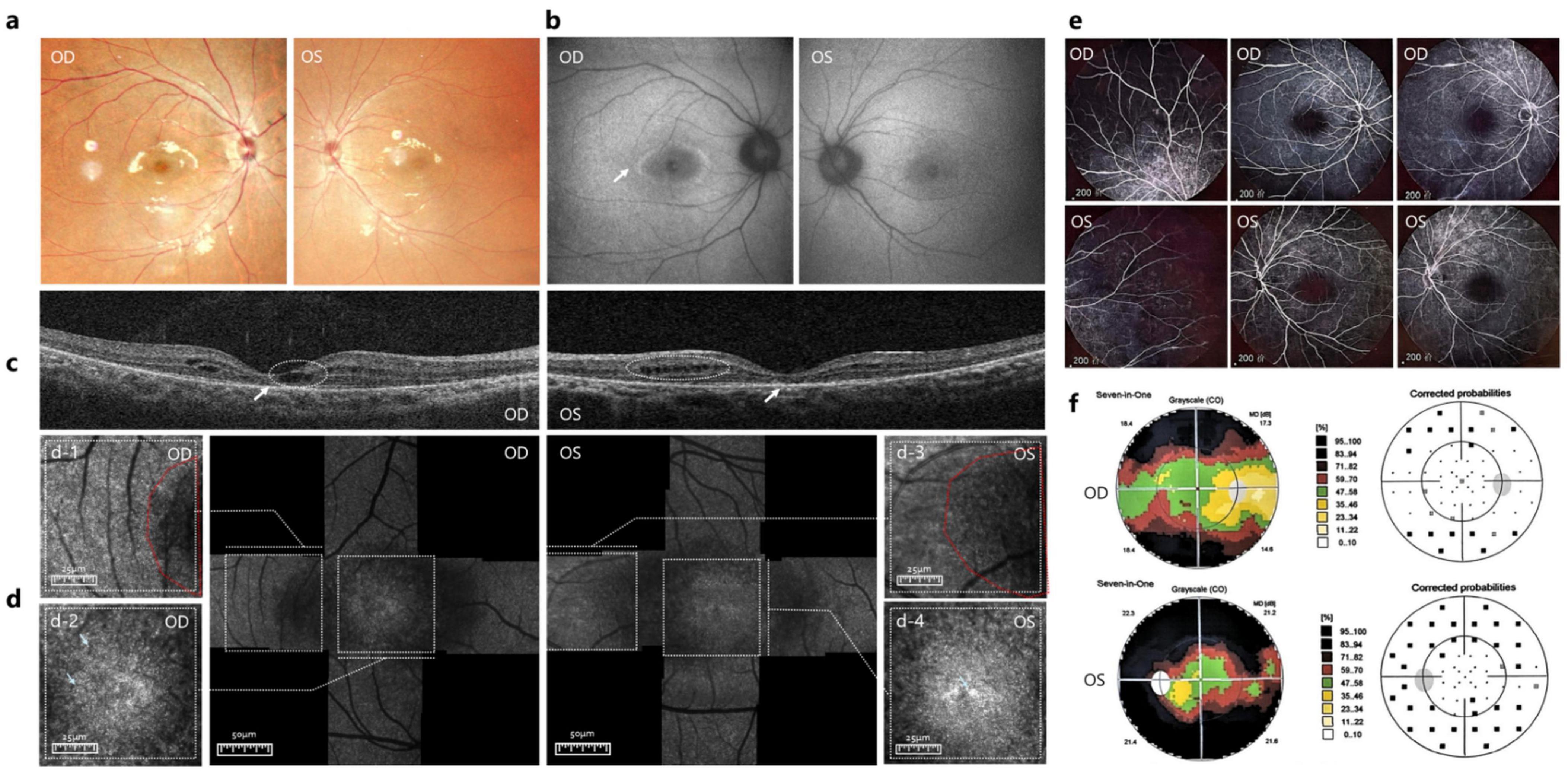 Composite image showing various diagnostic images of the eyes. Panel a displays colored fundus photographs of both eyes with visible blood vessels. Panel b shows black and white images with visible optic discs. Panel c presents cross-sectional OCT scans of the retina. Panel d illustrates segmented images with magnified sections showing detailed retinal layers. Panel e contains angiography scans highlighting blood vessel networks. Panel f displays visual field probability maps, with color-coded regions indicating different probabilities. Each panel includes labels for the right (OD) and left (OS) eyes.