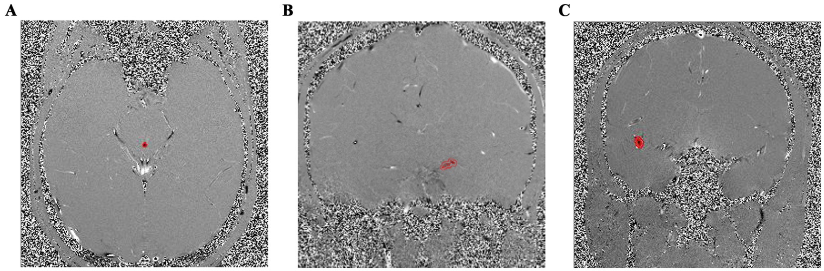 Three MRI scans labeled A, B, and C, each showing different cross-sections of the brain. Each scan has a distinct red-highlighted area indicating a specific region of interest in the brain tissue.