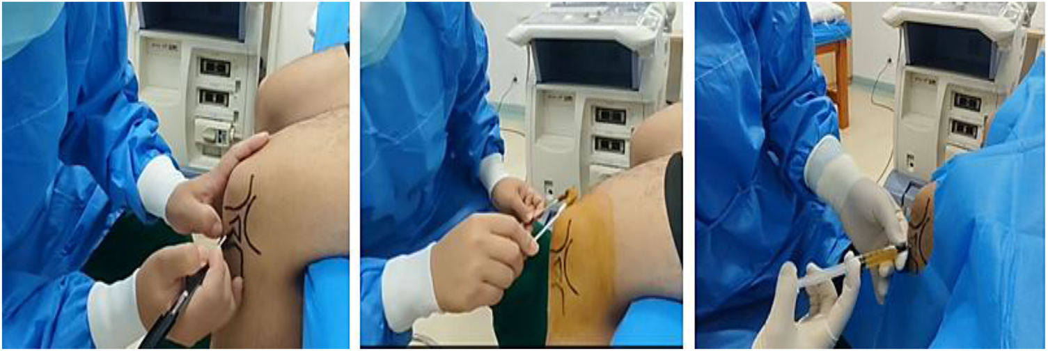 A medical procedure involves three steps. In the first image, a healthcare professional marks lines on a patient's knee. The second image shows antiseptic application. The third image depicts a needle inserted into the knee, with the professional in protective attire.