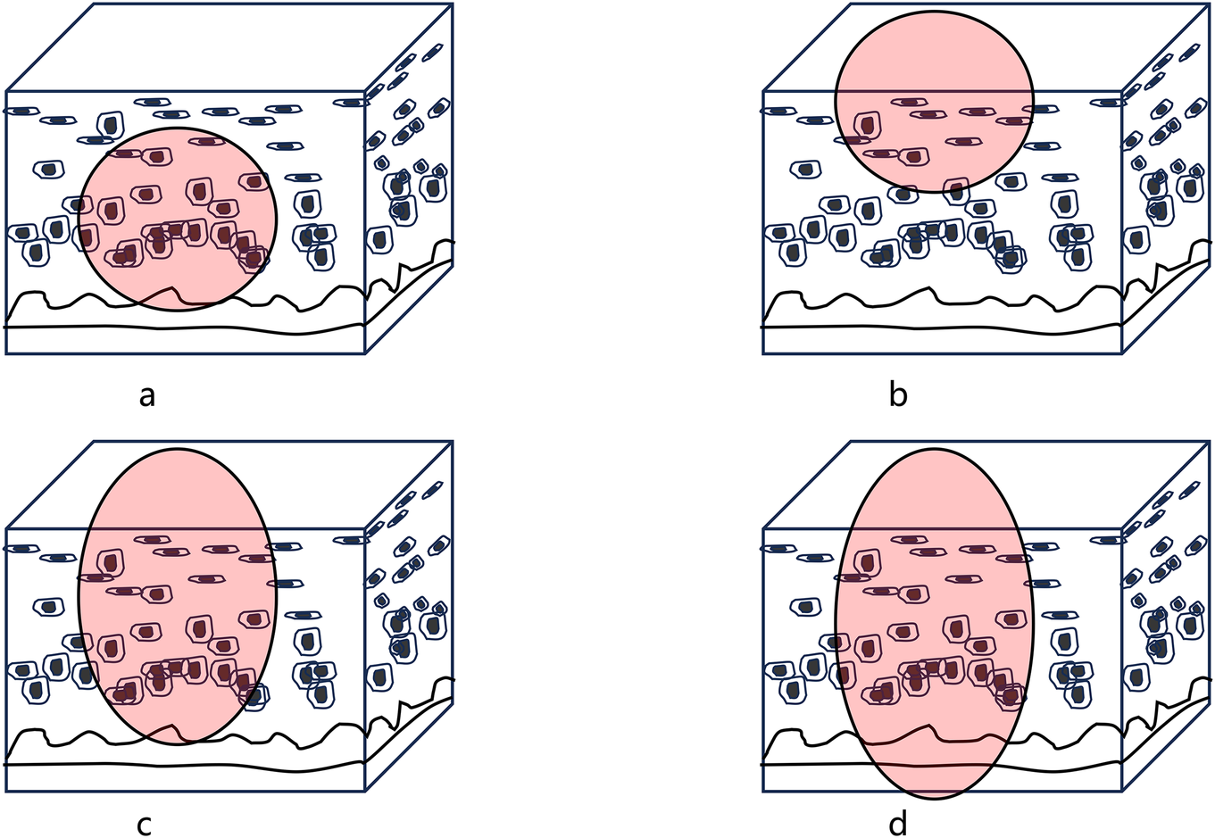 Four diagrams illustrate different stages of cartilage degeneration. Panel a shows delamination disappearing. Panel b indicates less than fifty percent involvement of the whole layer. Panel c depicts more than fifty percent deep involvement into the cartilage. Panel d shows whole layer involvement with subchondral bone exposure. Each diagram highlights the delaminated area in pink.