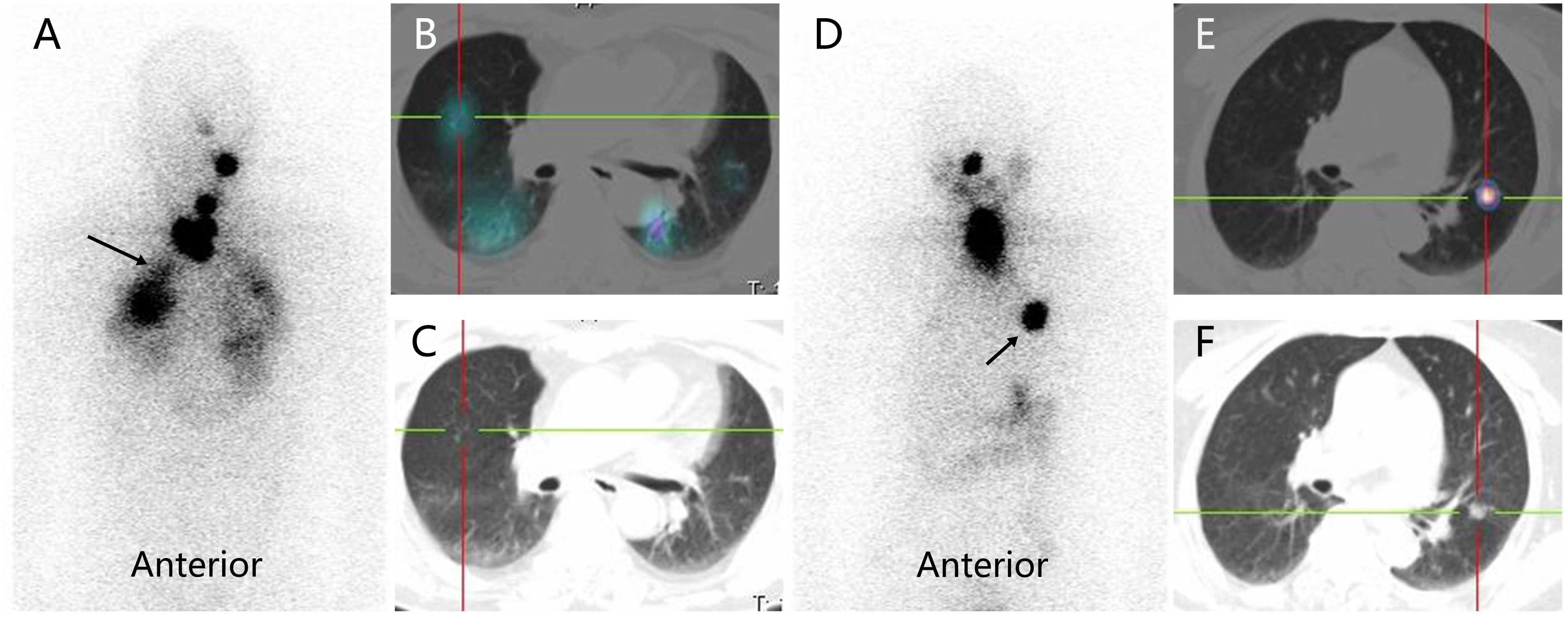 A set of six medical images labeled A to F. A and D show anterior views with areas of high uptake indicated by arrows. B, C, E, and F depict lung scans with crosshairs marked in red and green lines, showing sections of the pulmonary regions, indicating areas of interest or abnormality. Each image provides a different perspective for detailed analysis.