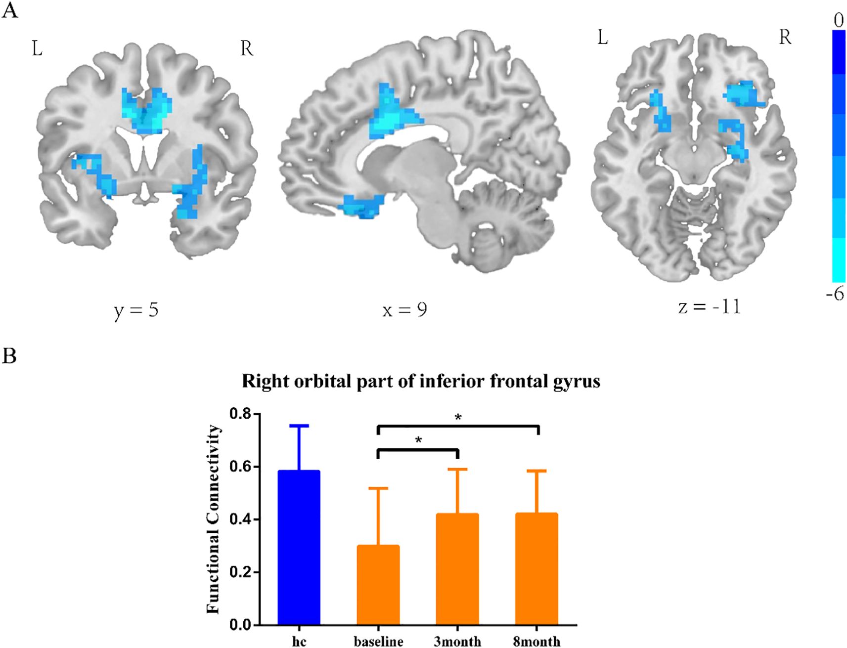 MRI brain scans and a bar graph illustrating functional connectivity changes. Panel A presents three brain slices with blue highlighted regions, each labeled with coordinates (y=5, x=9, z=-11). A color scale from zero to negative six is shown. Panel B depicts a bar graph of functional connectivity in the right orbital part of the inferior frontal gyrus. It compares healthy controls (blue) with baseline, three-month, and eight-month intervals (orange) with significant differences marked.
